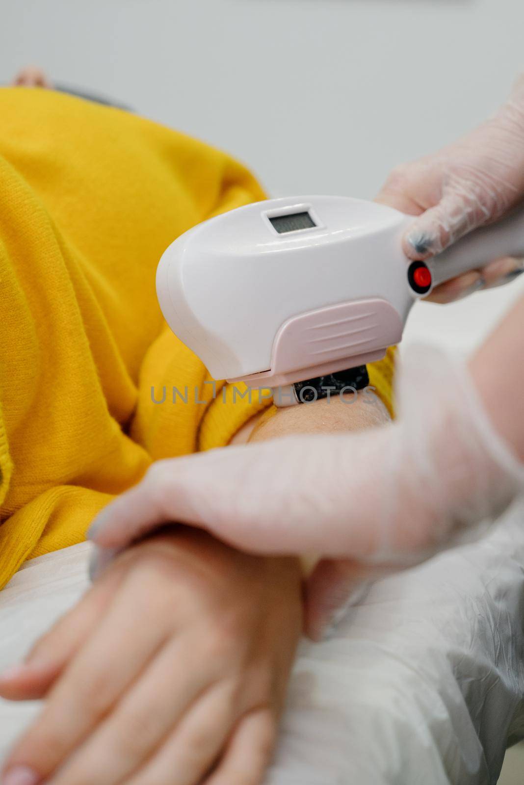 Hand Hair Removal.Cosmetological hair removal procedure from a therapist in a beauty spa clinic. Laser hair removal. Cosmetology and SPA concept.