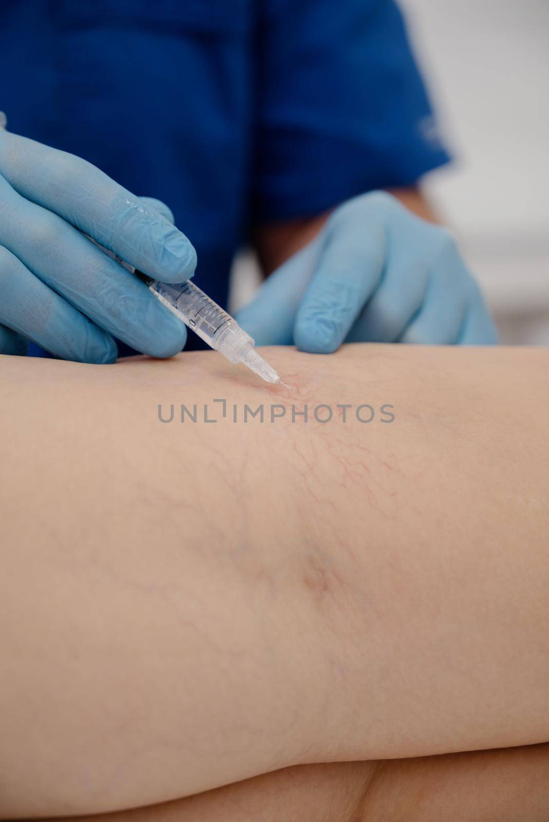 Removal of varicose veins on the legs.The doctor performs a medical sclerotherapy procedure used to eliminate varicose veins and vascular asterisks.