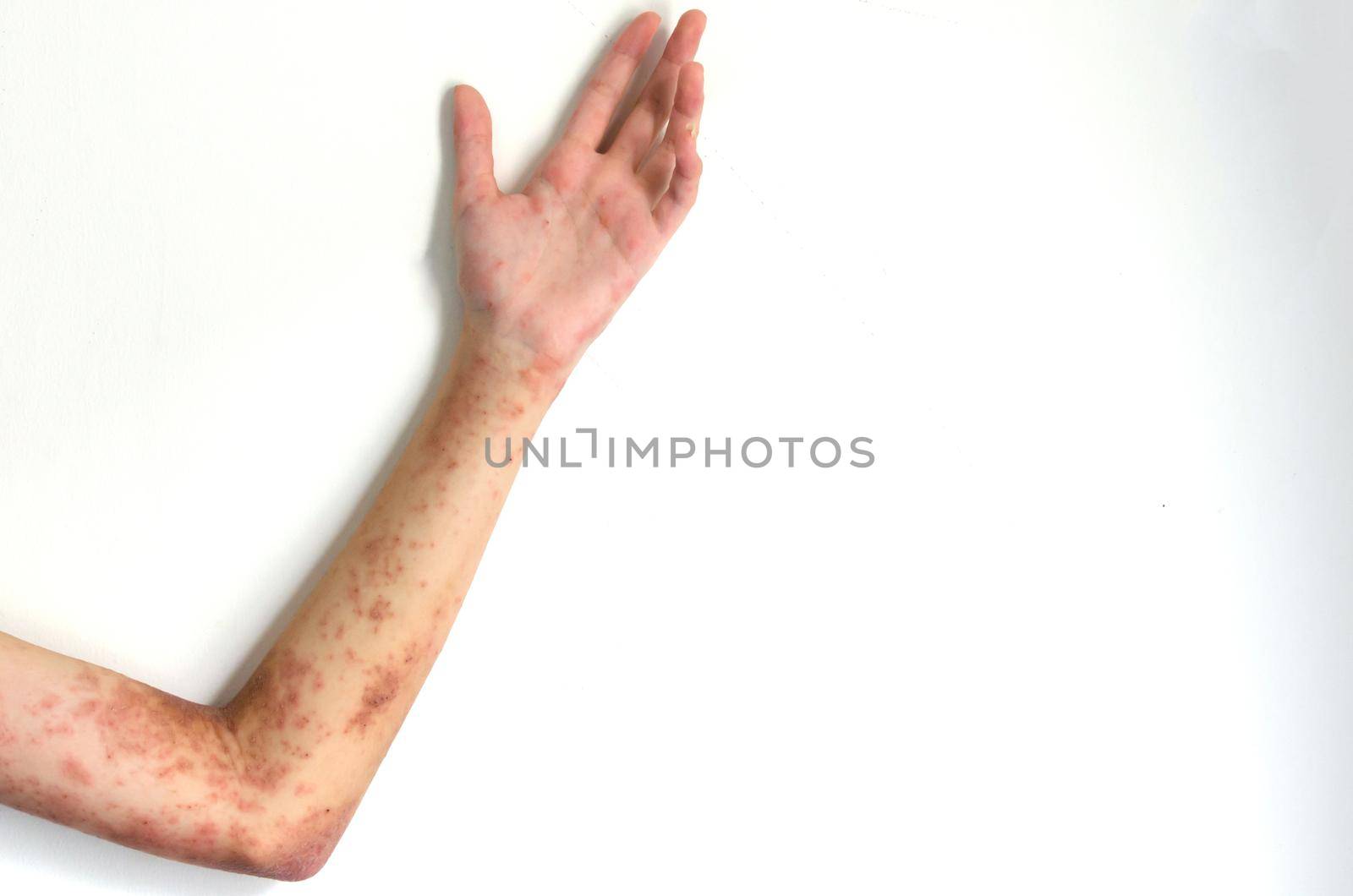 Treatment for atopic dermatitis an infection and itching on a girl arm involves administering medicine. by aoo3771