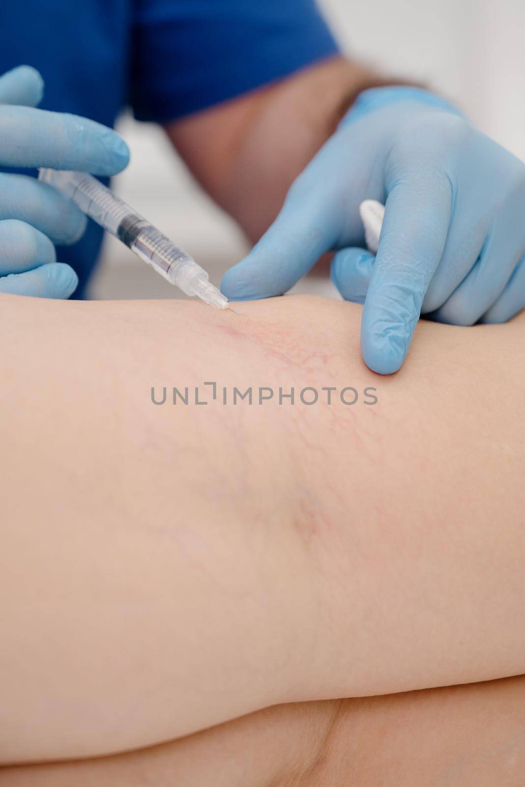 Removal of varicose veins on the legs.The doctor performs a medical sclerotherapy procedure used to eliminate varicose veins and vascular asterisks.