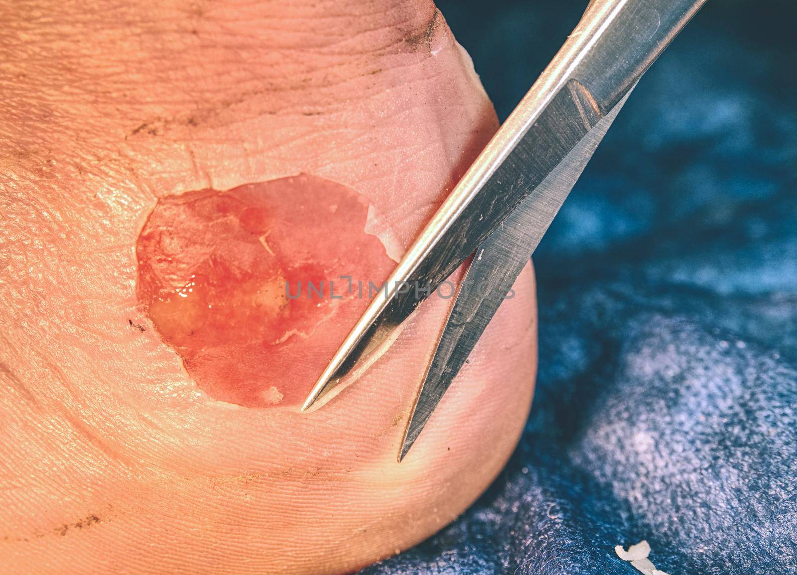 Nurse cleaning dead skin on patient leg with spike scissors, blue sterile background.  Deep scratches on the skin with bruises and wet tracks