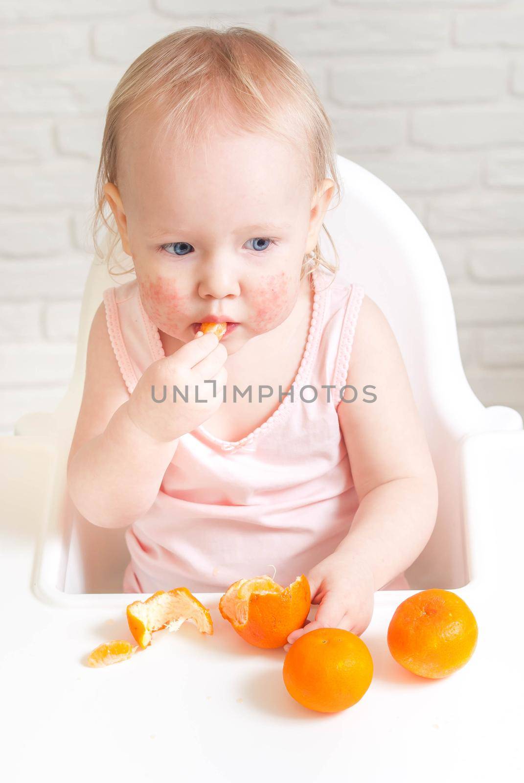 Cute child toddler with food allergy on face. High quality photo