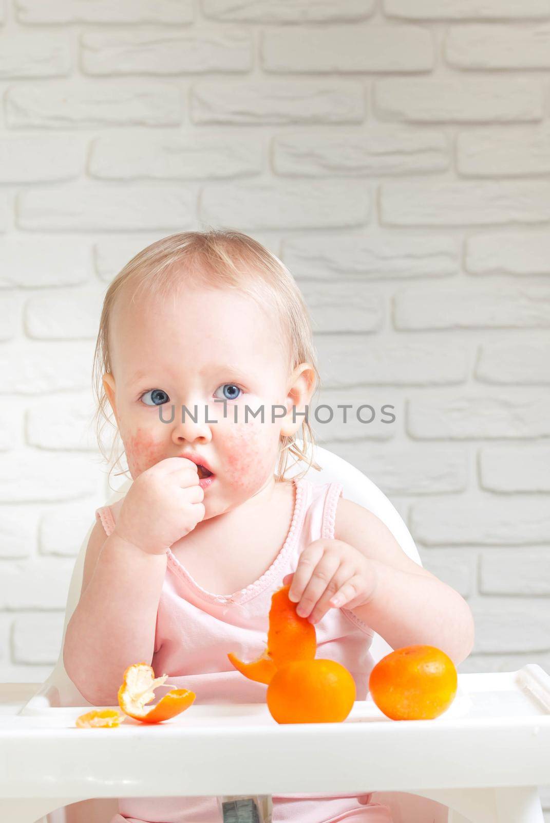 Cute child toddler with food allergy on face. High quality photo