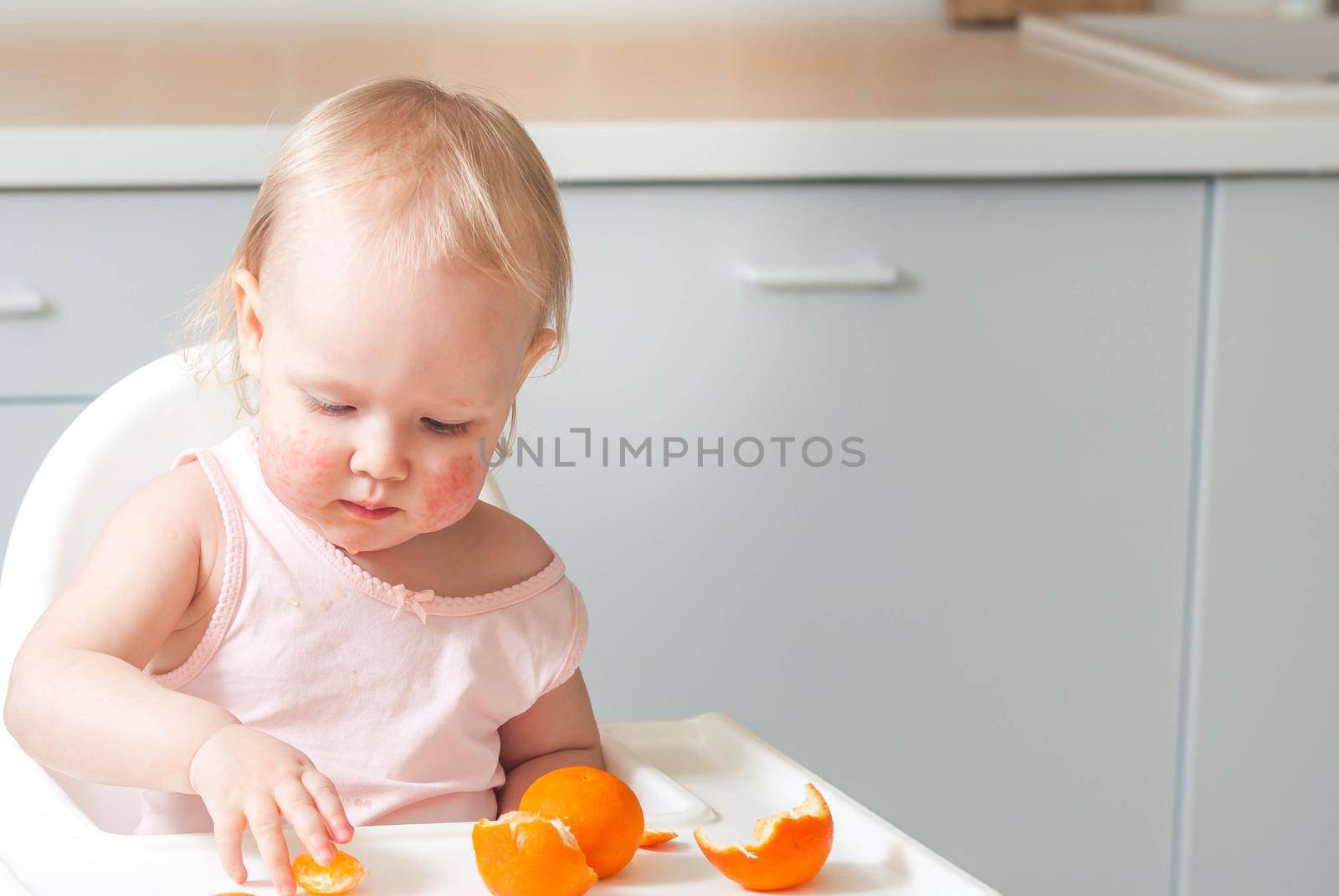 Cute child toddler with food allergy on face. High quality photo