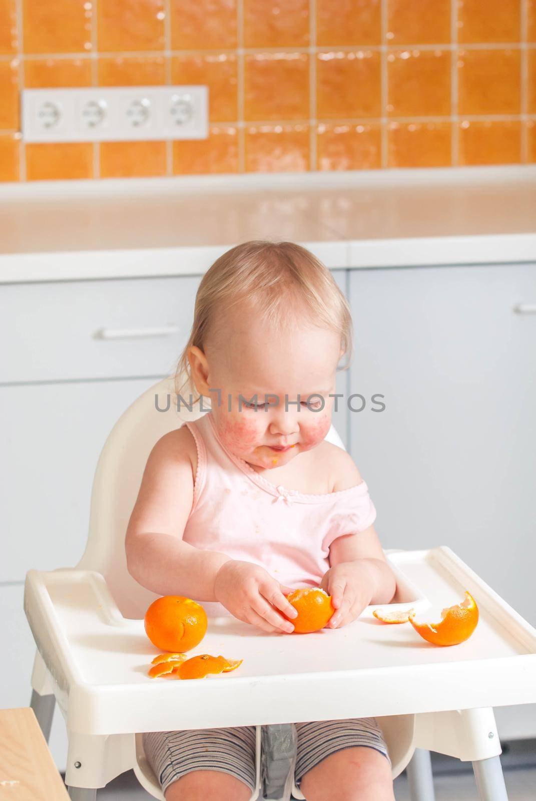 Cute child toddler with food allergy on face. High quality photo