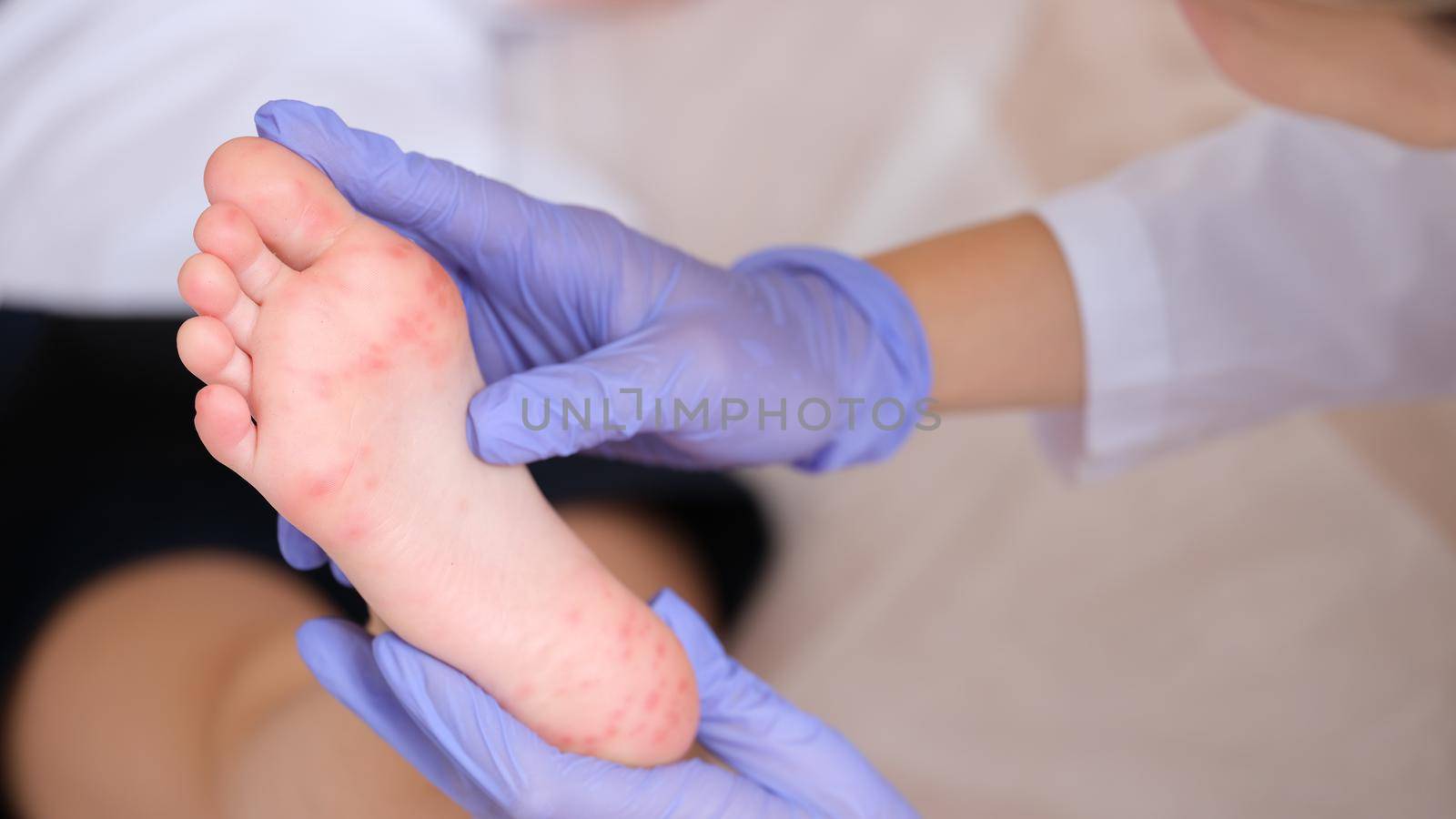 Rash with enterovirus infection of picornavirus family on feet of child by kuprevich