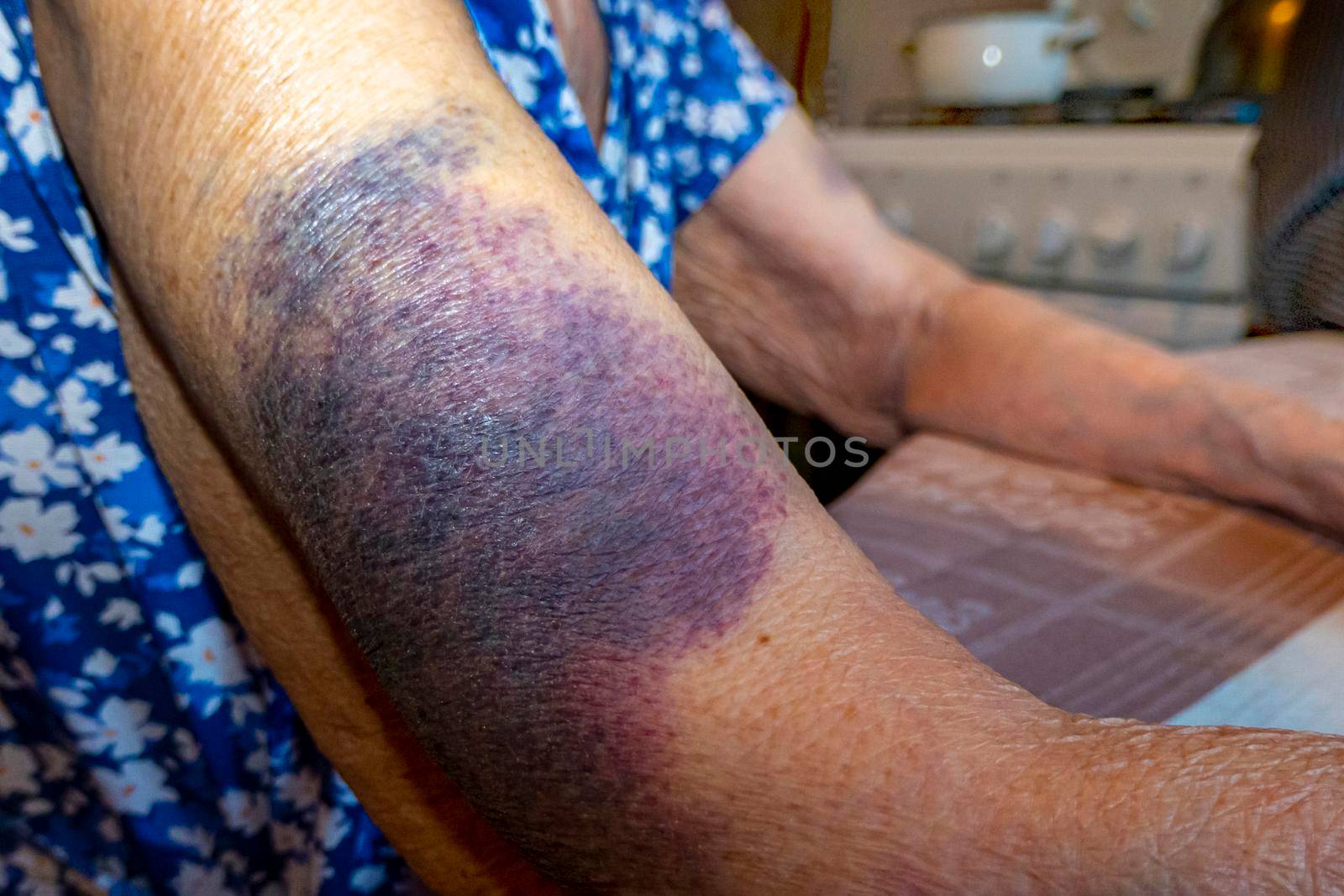 A bruise after an unsuccessful fall on the hands of an elderly man. Old age. wrinkled skin. an elderly woman with bruises on her hands is playing cards, keeping score