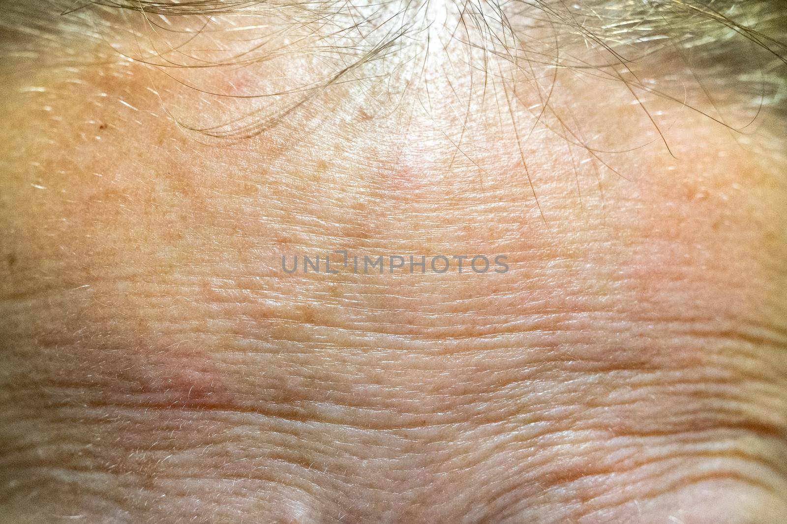 The forehead of a woman with problematic skin.