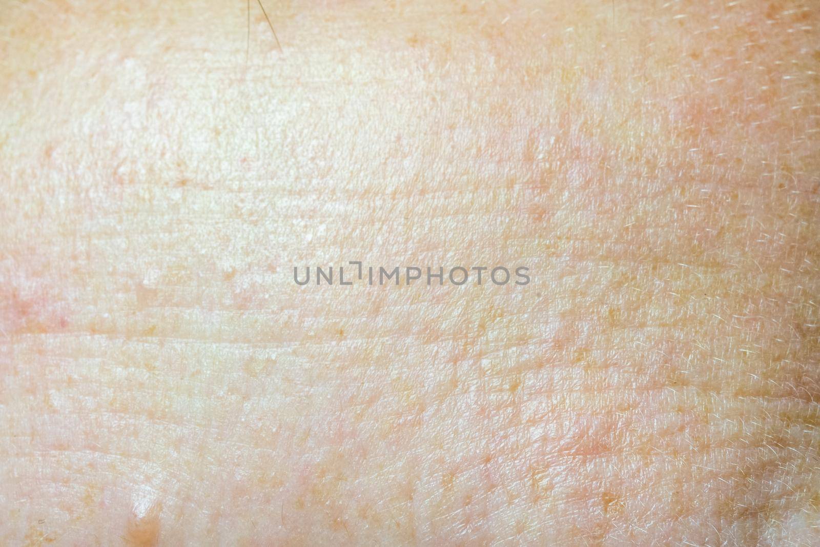 The forehead of a woman with problematic skin. Clous up by Serhii_Voroshchuk