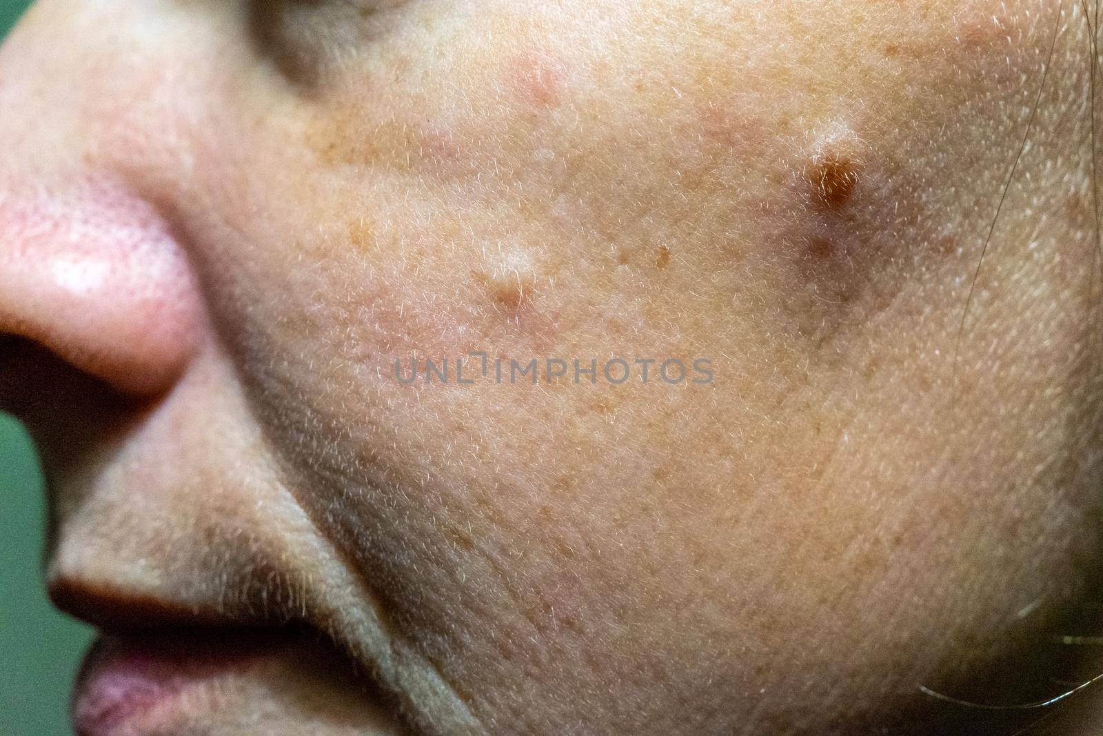 Close-up of a woman's cheek with problem skin.