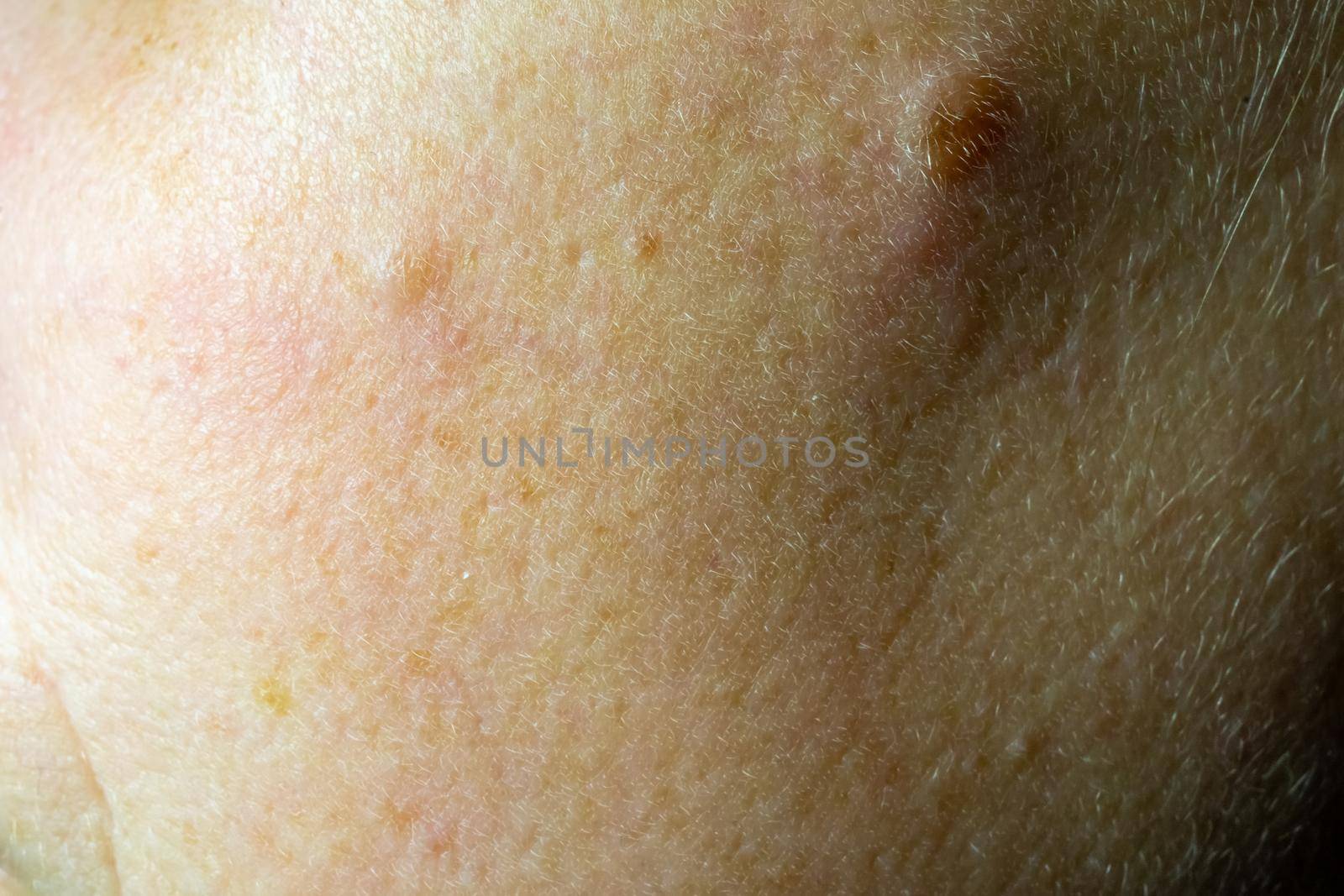 Close-up of a woman's cheek with problem skin by Serhii_Voroshchuk