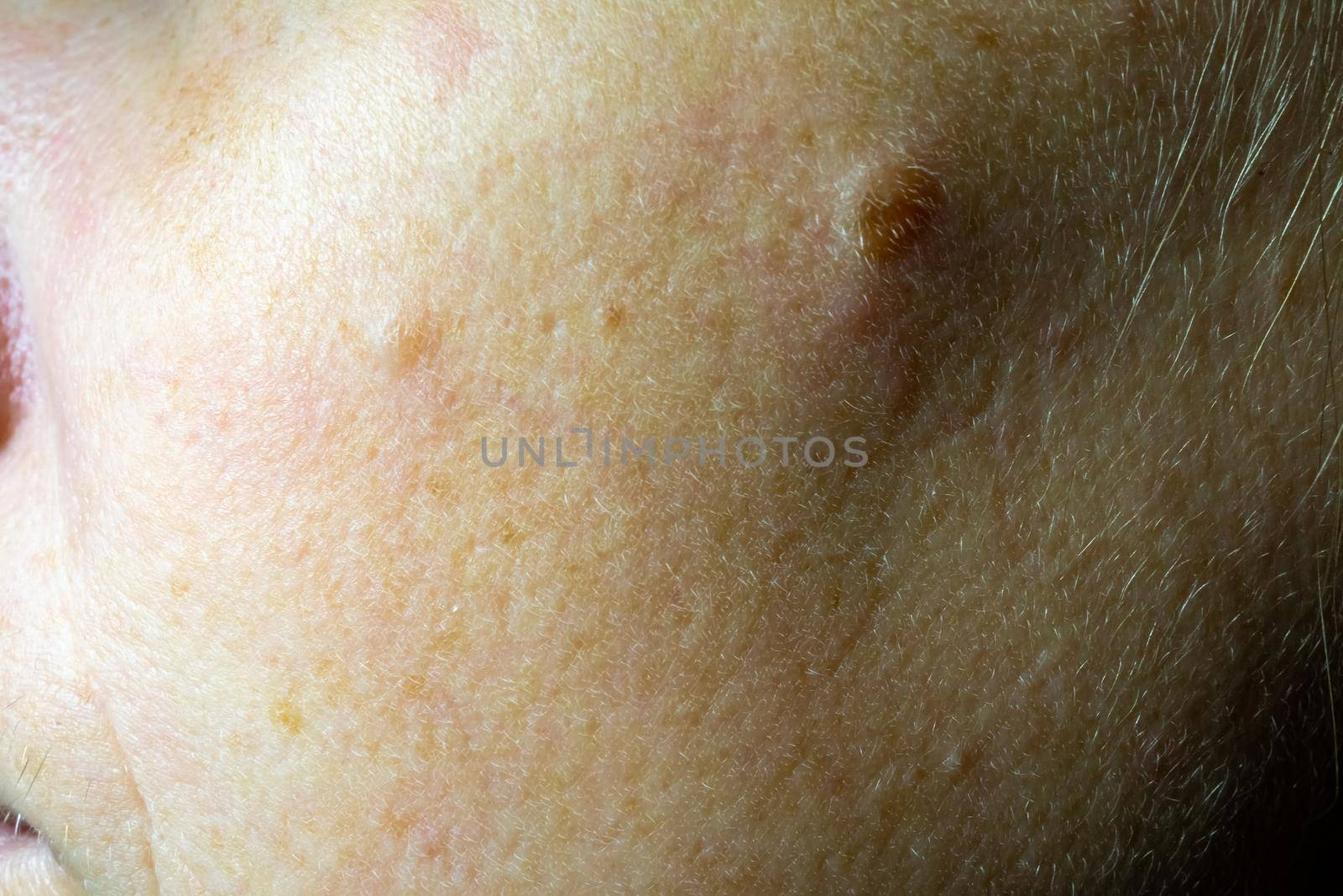 Close-up of a woman's cheek with problem skin. Soft focus