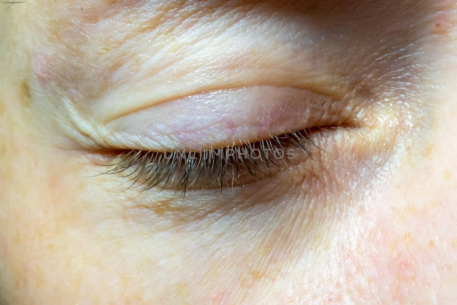 Woman's closed eye close-up. Problematic skin near the eye.