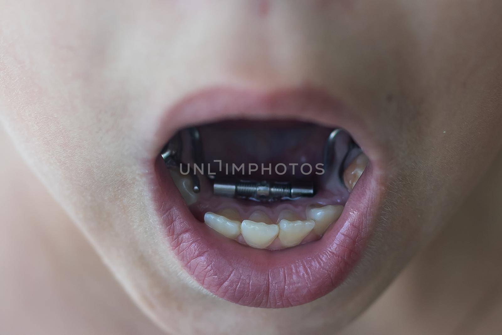 Cropped view of the little girl having her plates checked. Close-up portrait of smiling teenage girl with teeth plates against dentist sitting in clinic. Girl with plates being examined by dentist. by Andelov13