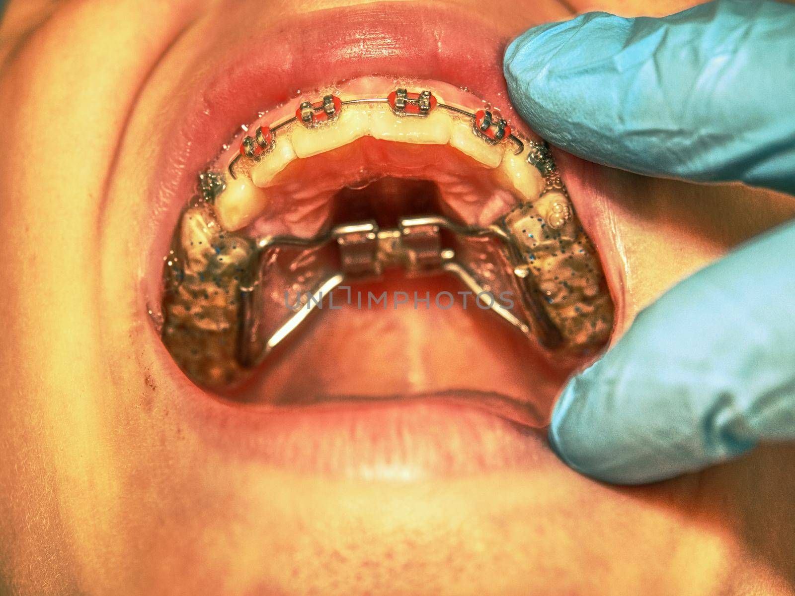 Prague, Czech Republic September 28th 2018.  Dental braces in a young boy mouth. Teen with braces on his teeth. Macro shot of teeth with braces. Orthodontic Treatment. 