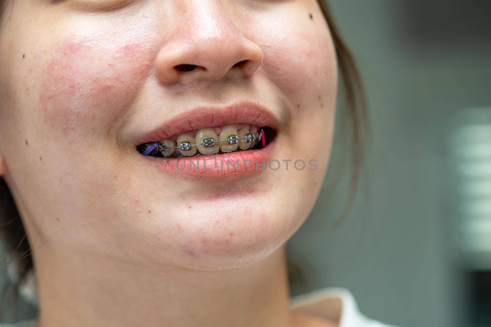 Braces in teenage girl mouth to treat and beauty for increase confidence and good personality.
