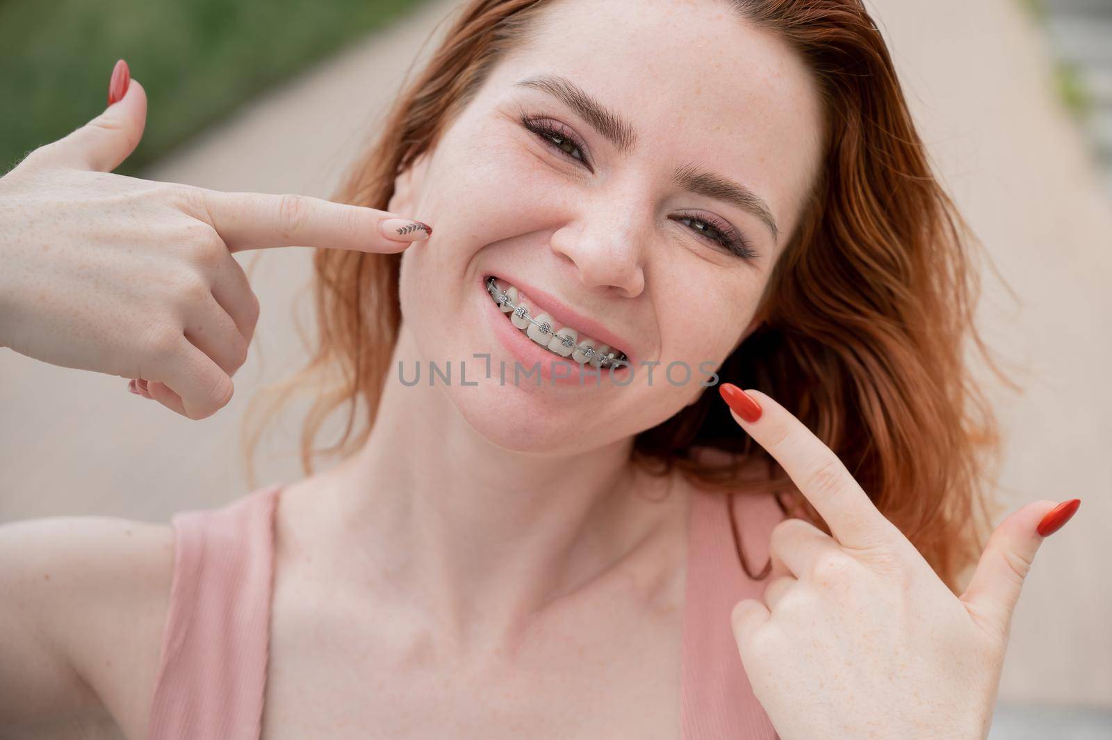 Young red-haired woman with braces on her teeth point to a smile outdoors in summer.