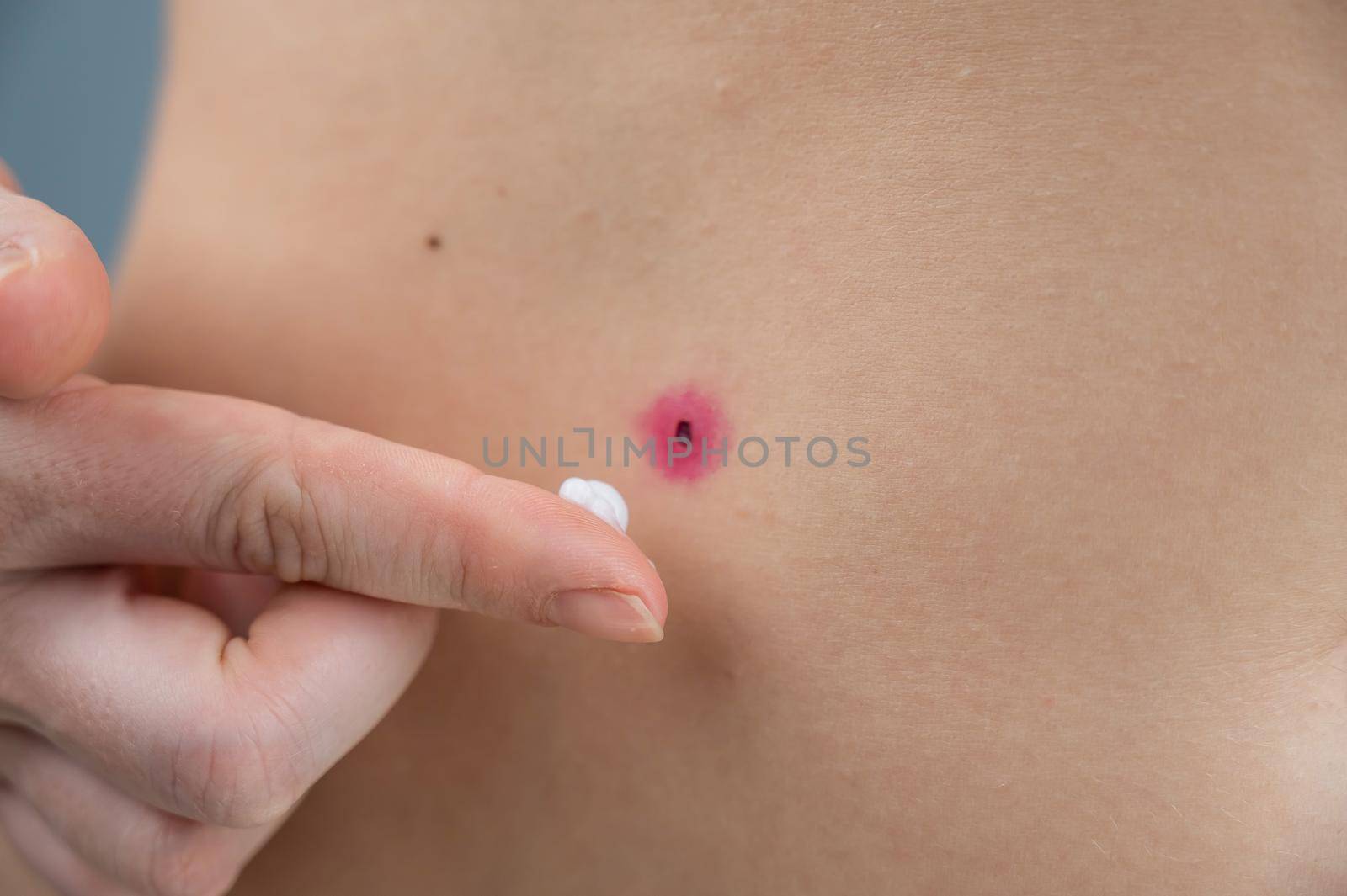 A woman smears cream on a wound after burning a wart