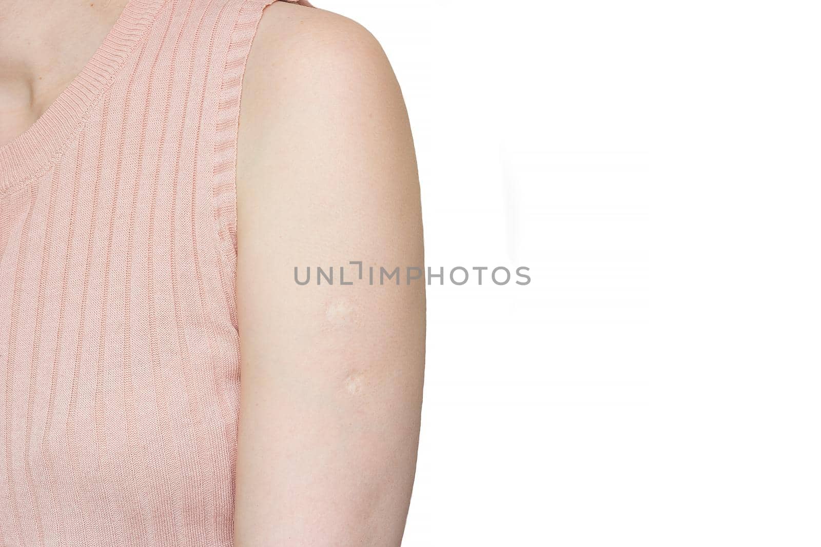 Two tuberculosis vaccine BCG marks made in childhood are visible on the shoulder of an adult woman