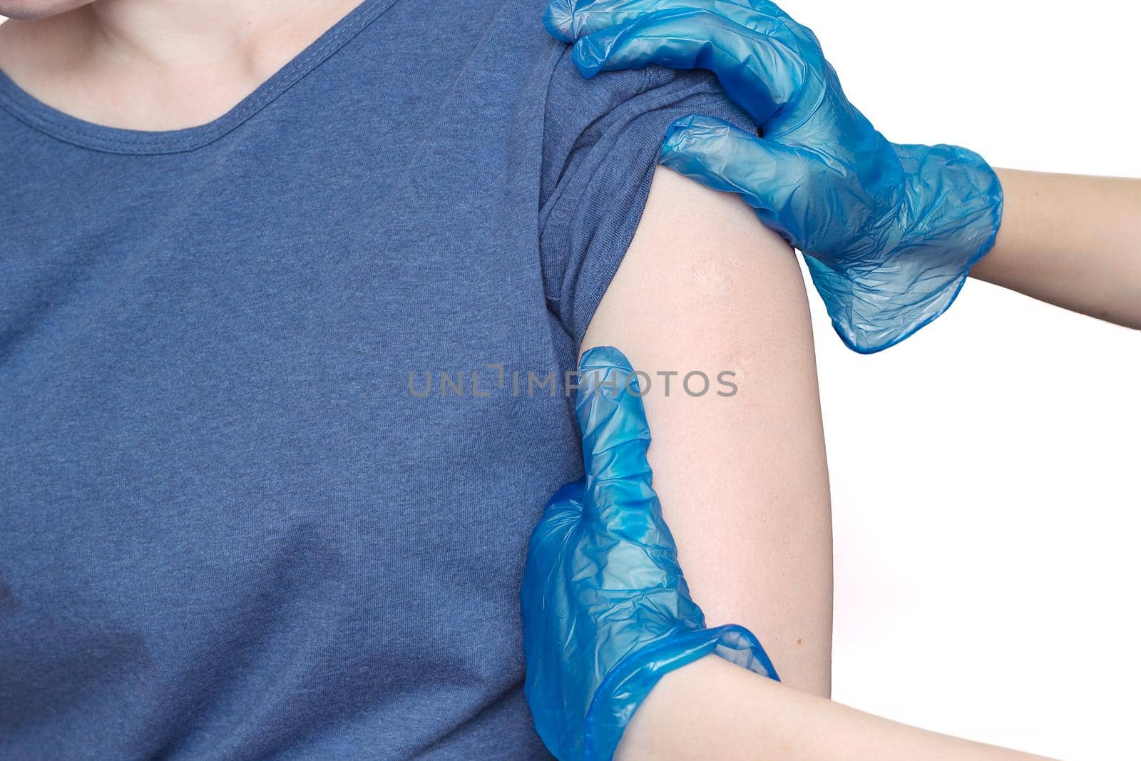 Doctor or nurse examine two tuberculosis vaccine BCG marks on the shoulder of an adult woman made in childhood