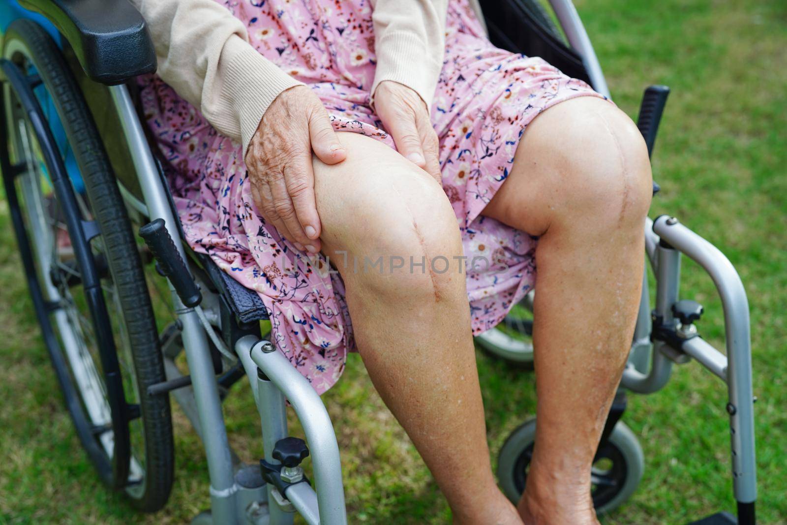 Asian elderly woman patient with scar knee replacement surgery in hospital.