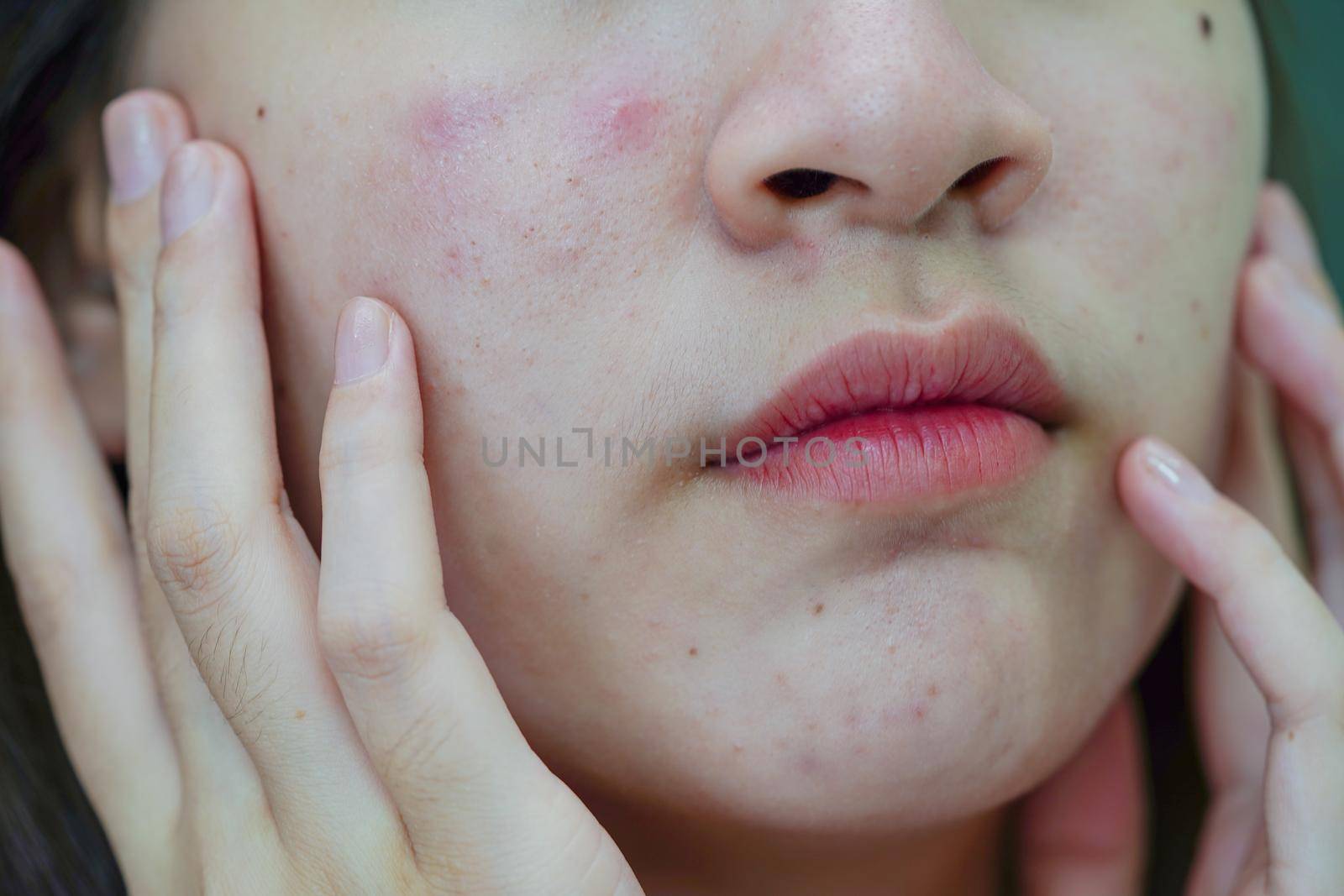 Acne pimple and scar on skin face, disorders of sebaceous glands, teenage girl skincare beauty problem.