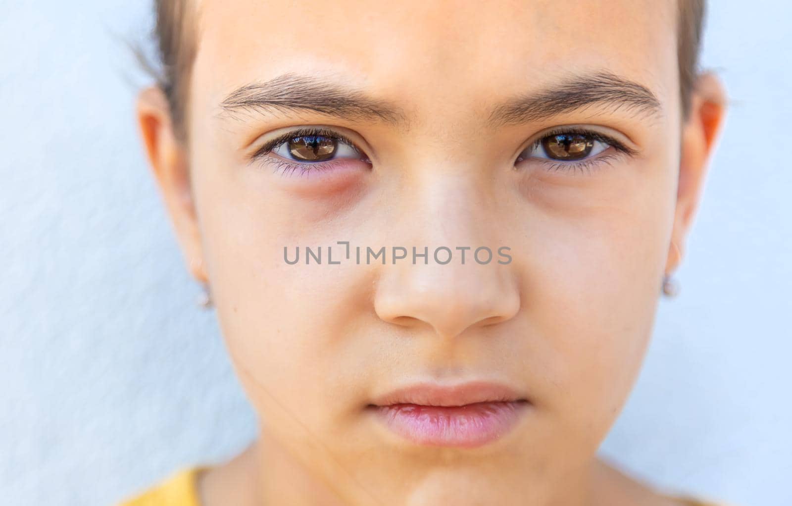 The child eye is inflamed. Selective focus. Kid.