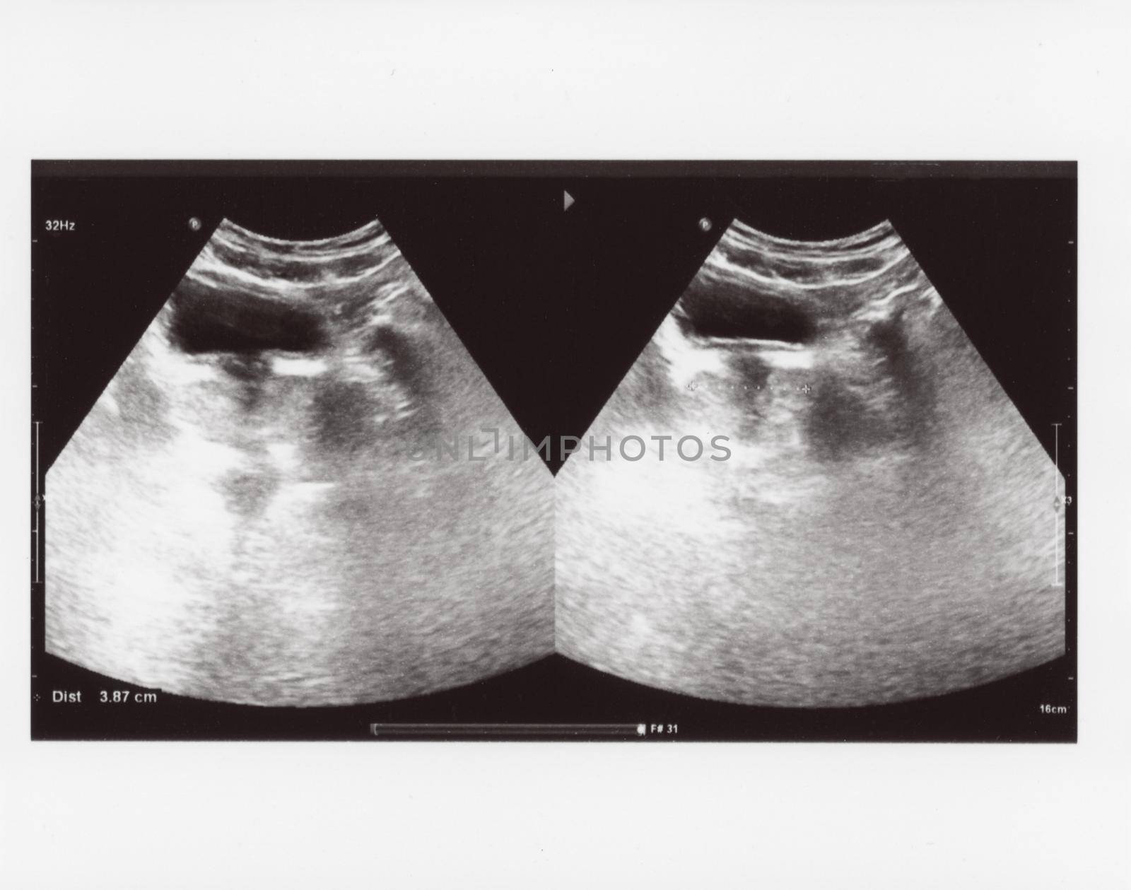 full abdomen ultrasound image aka diagnostic sonogram