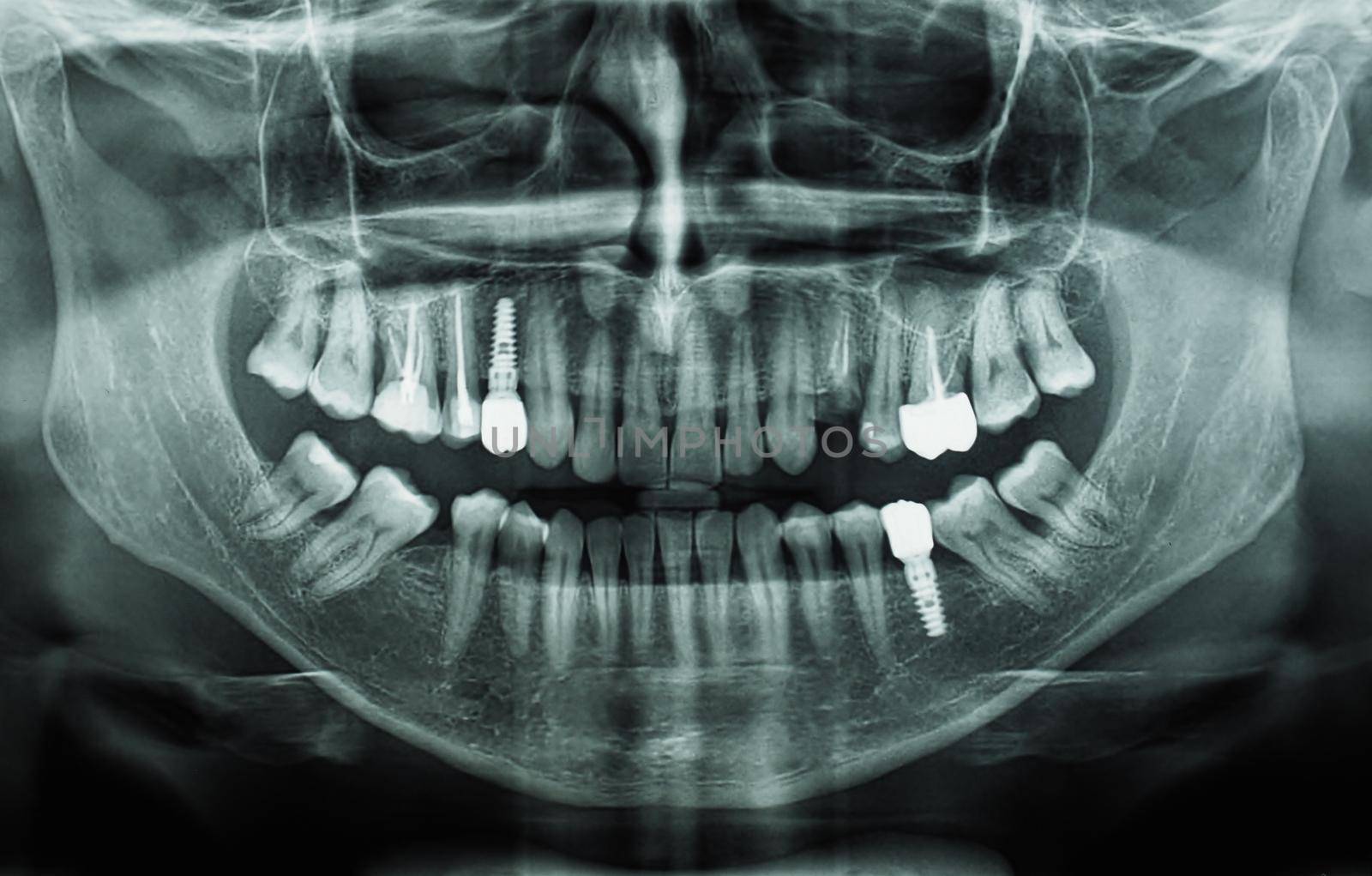 orthopantomogram single panoramic image radiograph of the mandible, maxilla and teeth