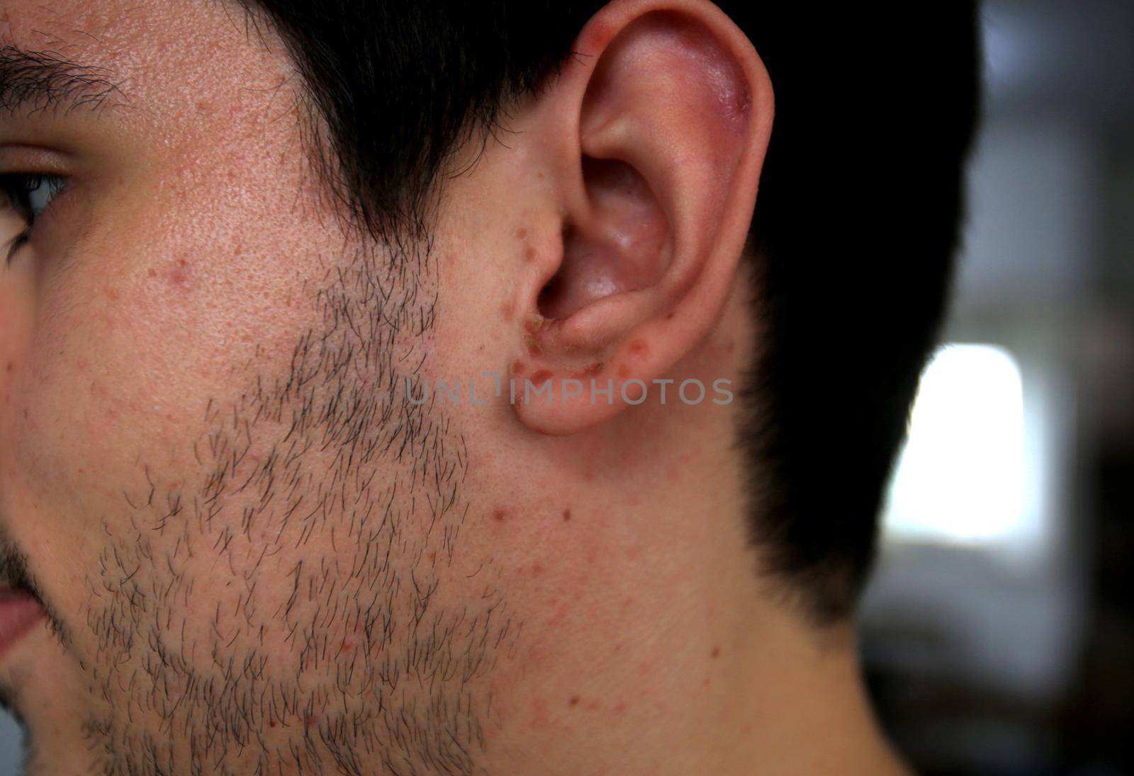 salvador, bahia / brazil - april 11, 2019: man shows body parts infected with symptoms of hand and foot and mouth syndrome, known as Roseola.
