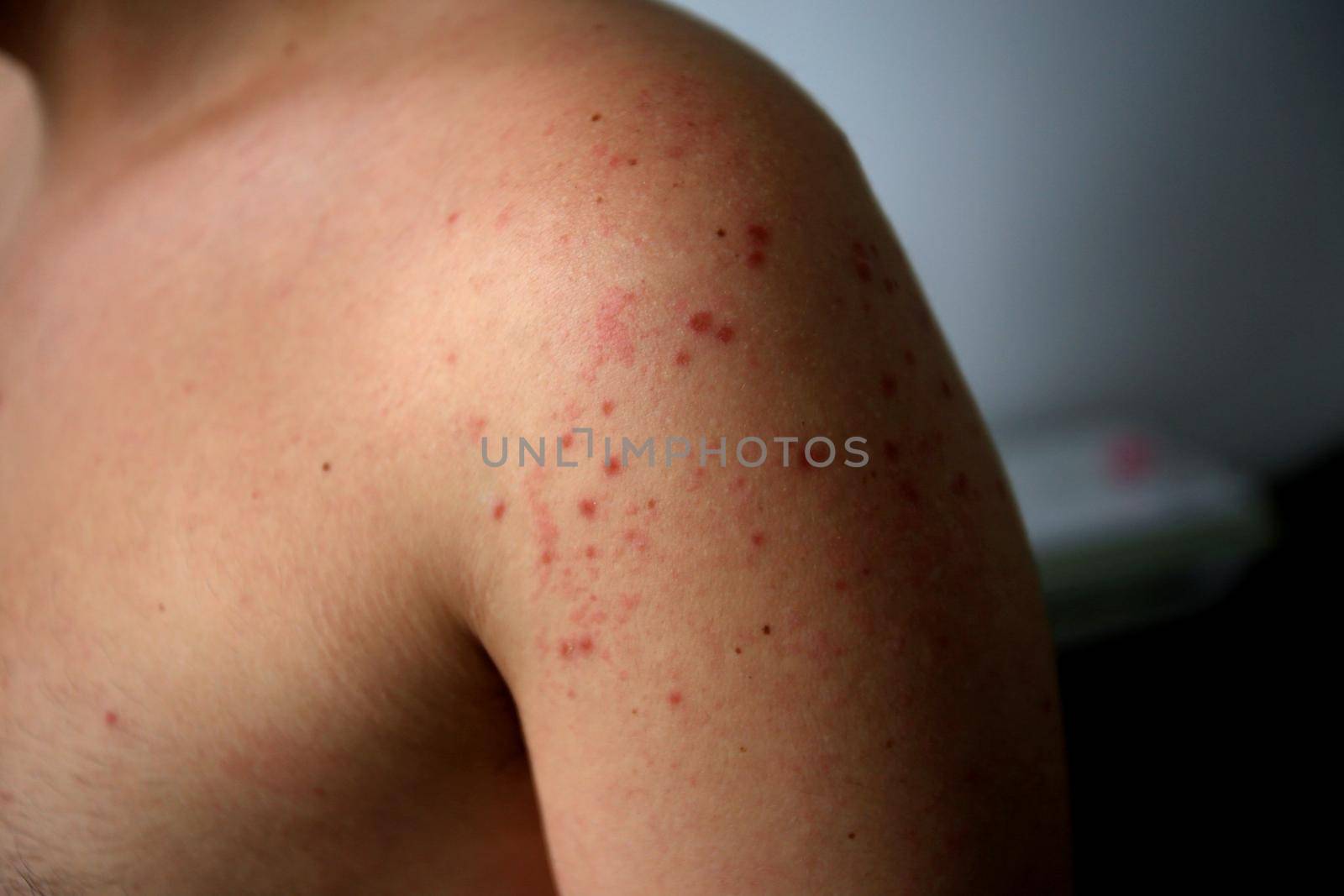 salvador, bahia / brazil - april 11, 2019: man shows body parts infected with symptoms of hand and foot and mouth syndrome, known as Roseola.
