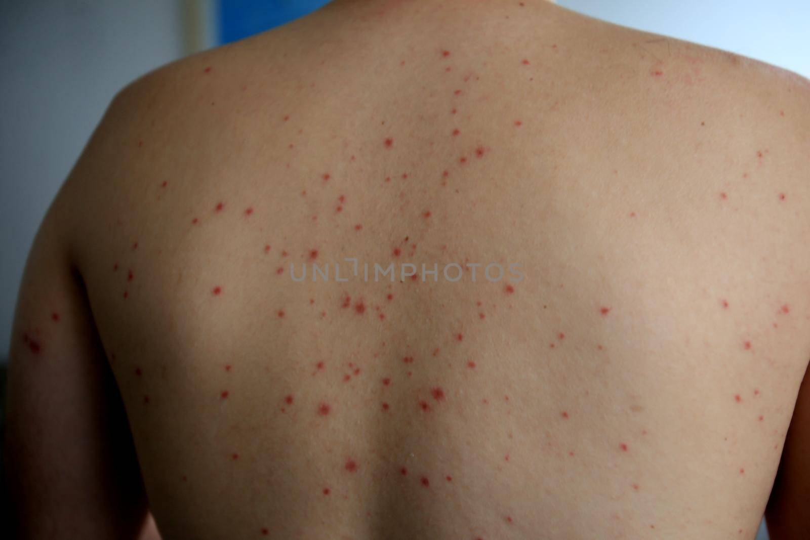 salvador, bahia / brazil - april 11, 2019: man shows body parts infected with symptoms of hand and foot and mouth syndrome, known as Roseola.
