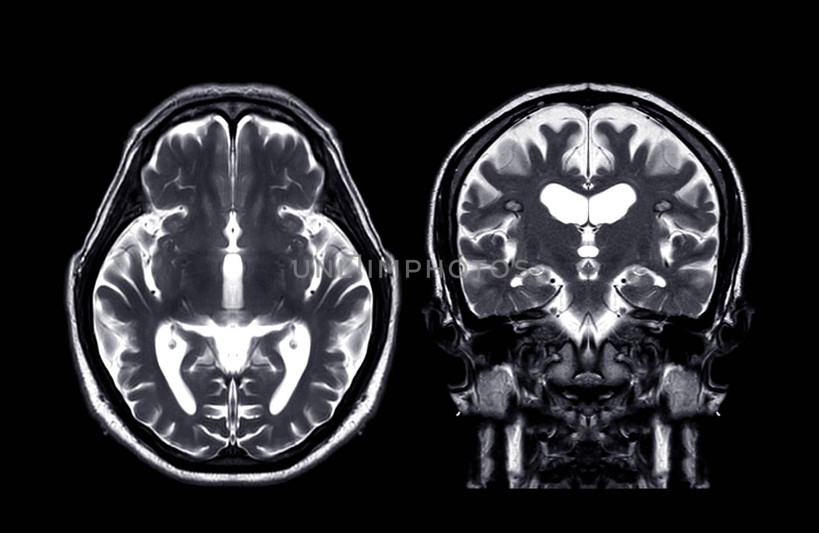 MRI brain Axial T2 and coronal t2 f technique by samunella