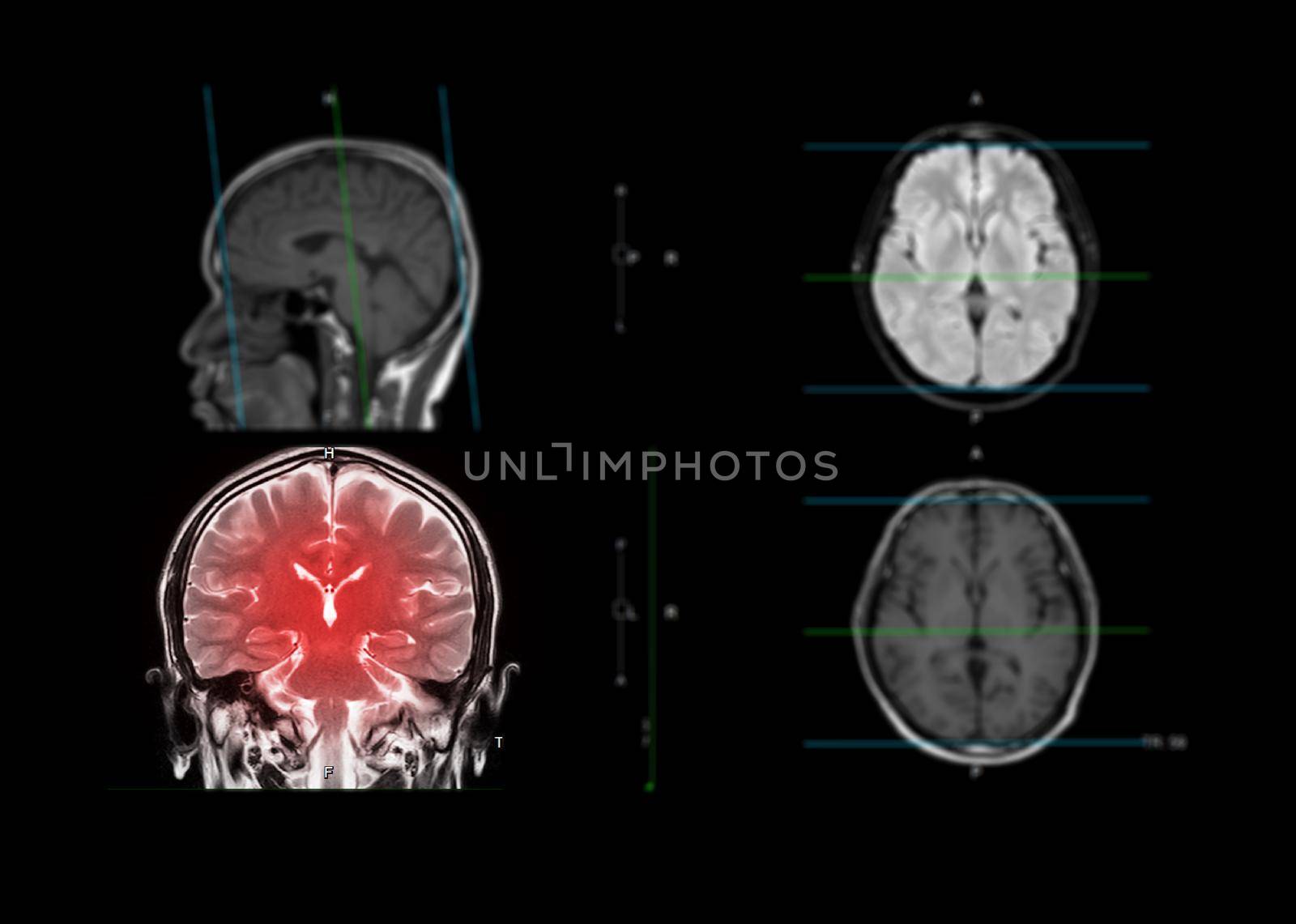 MRI brain showing coronal plane of the brain for detect stroke disease and Brain tumors and cysts.