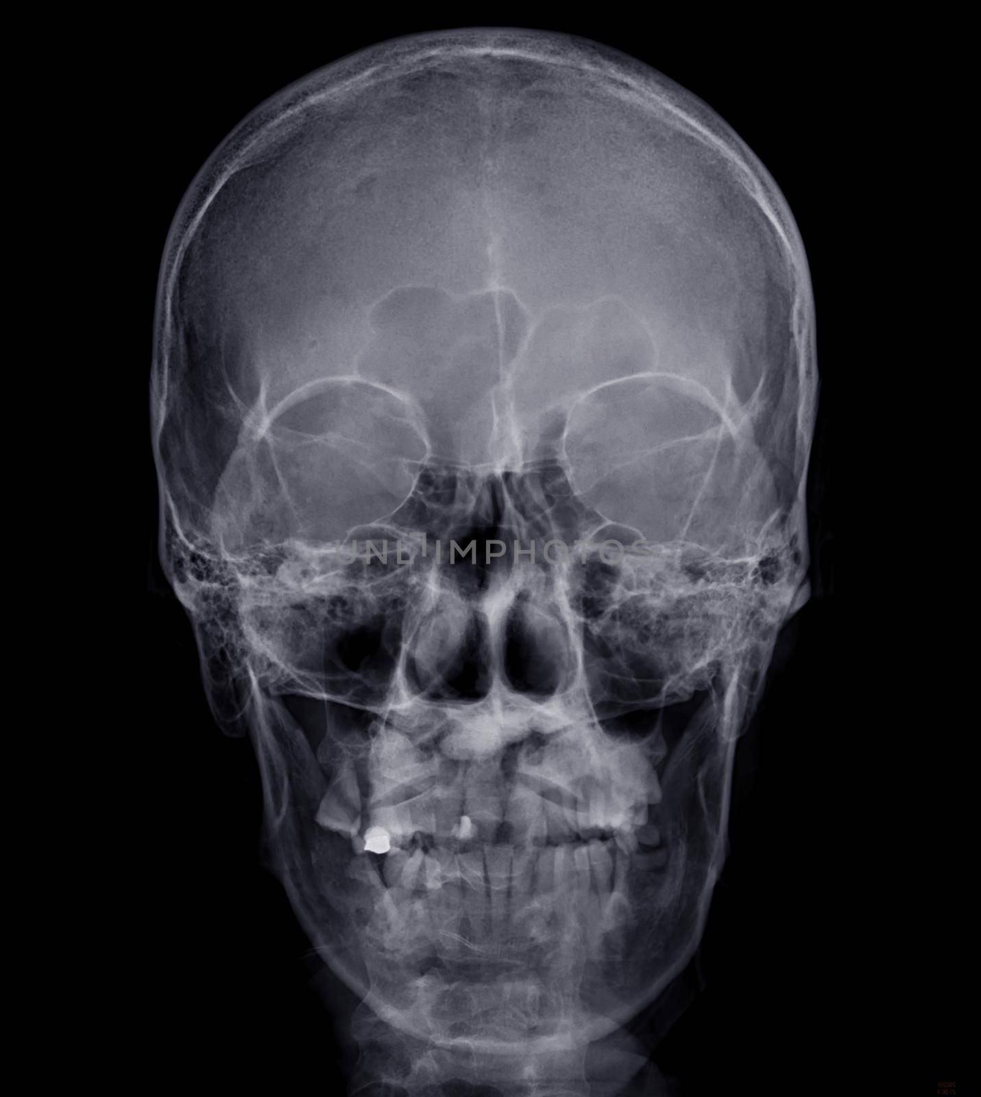 Skull x-ray image of Human name is skull AP view .isolated on Black Background.