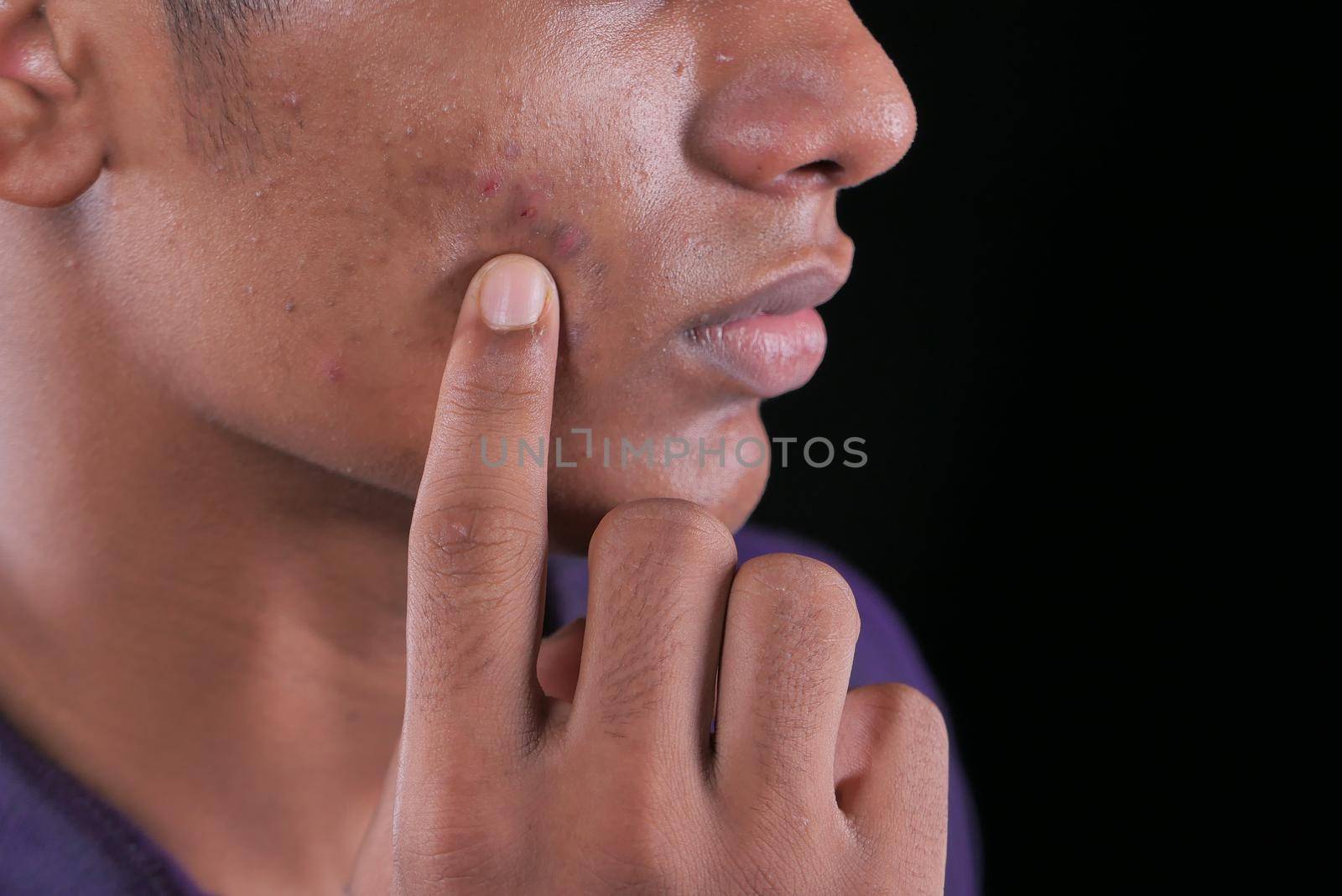 close up of young man face with skin problem