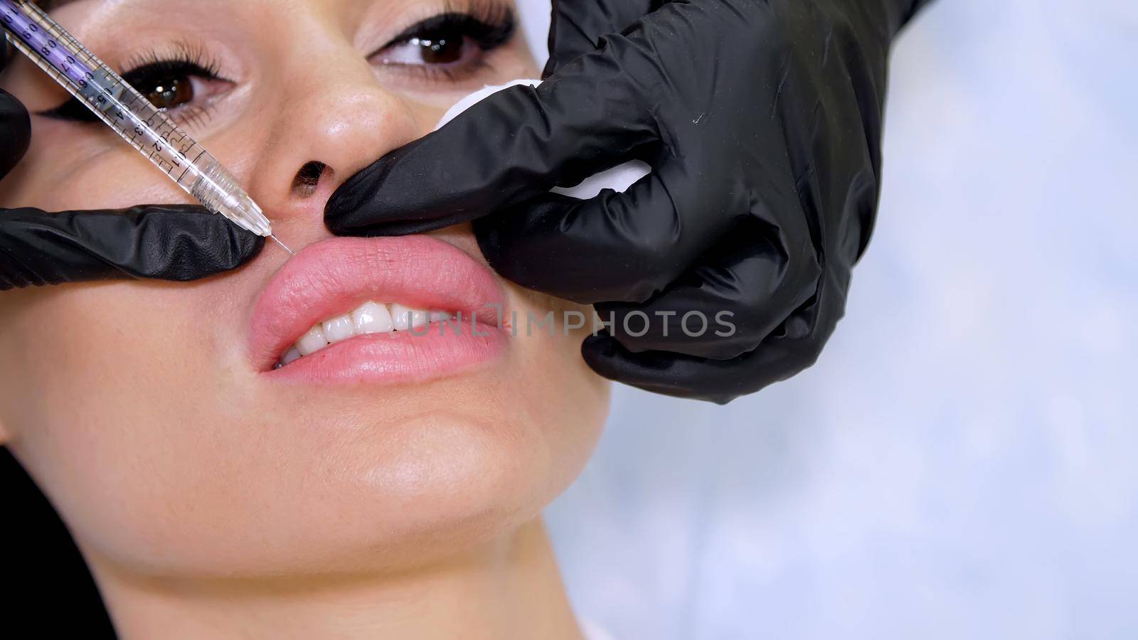 medical office, doctor in black sterile gloves, injecting hyaluronic acid into the patient lips. Procedure for increasing the volume of lips, correction of lips shape. High quality photo