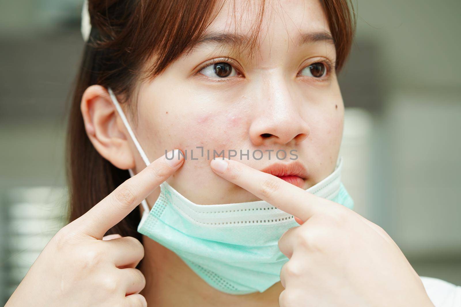 Acne pimple and scar on skin face, disorders of sebaceous glands, teenage girl skincare beauty problem.
