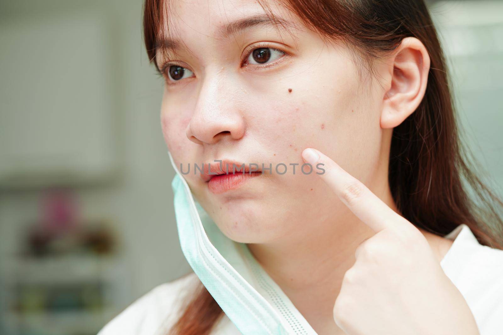 Acne pimple and scar on skin face, disorders of sebaceous glands, teenage girl skincare beauty problem.