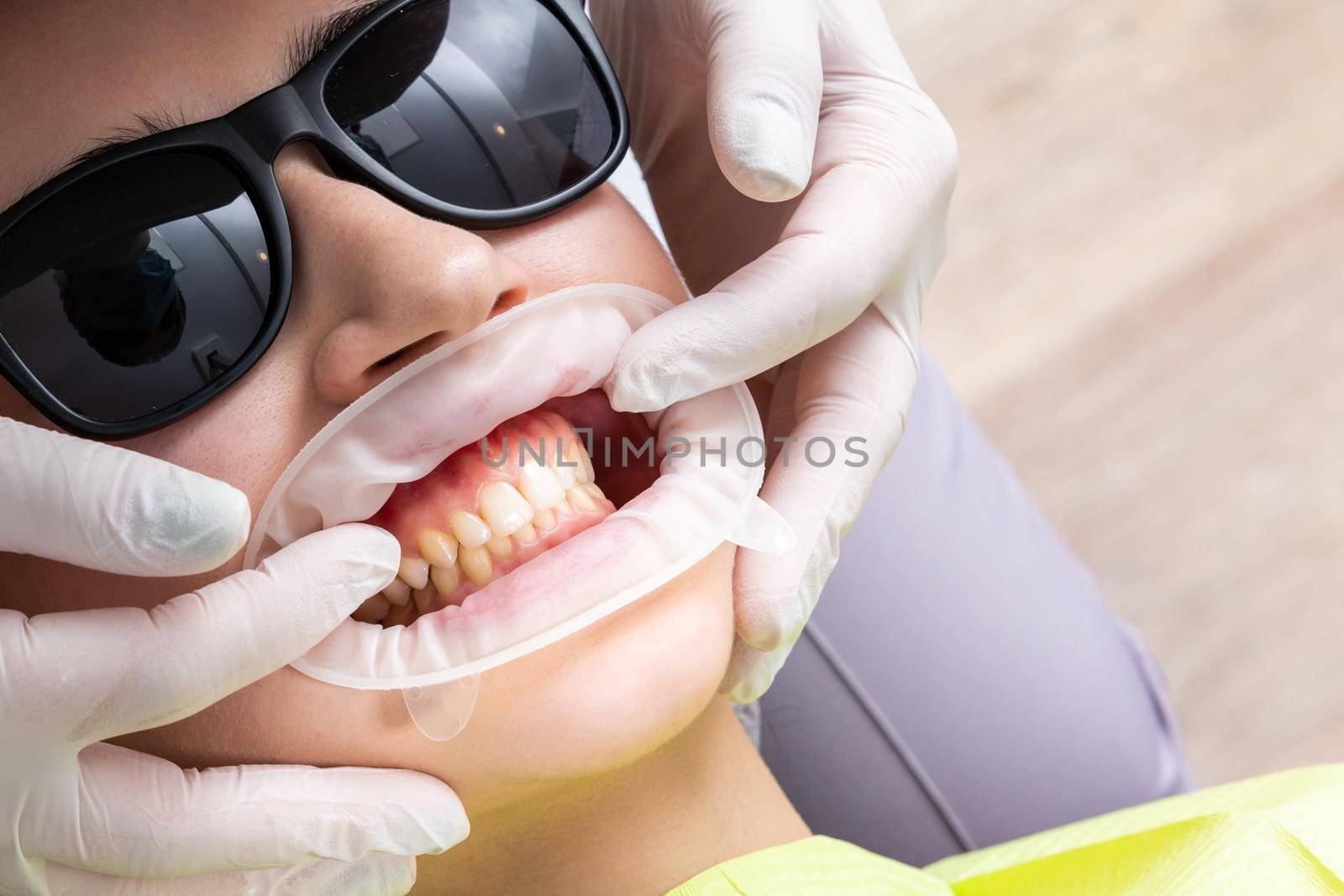 Dentist installing a patient cheek retractor in dentist office by Mariakray