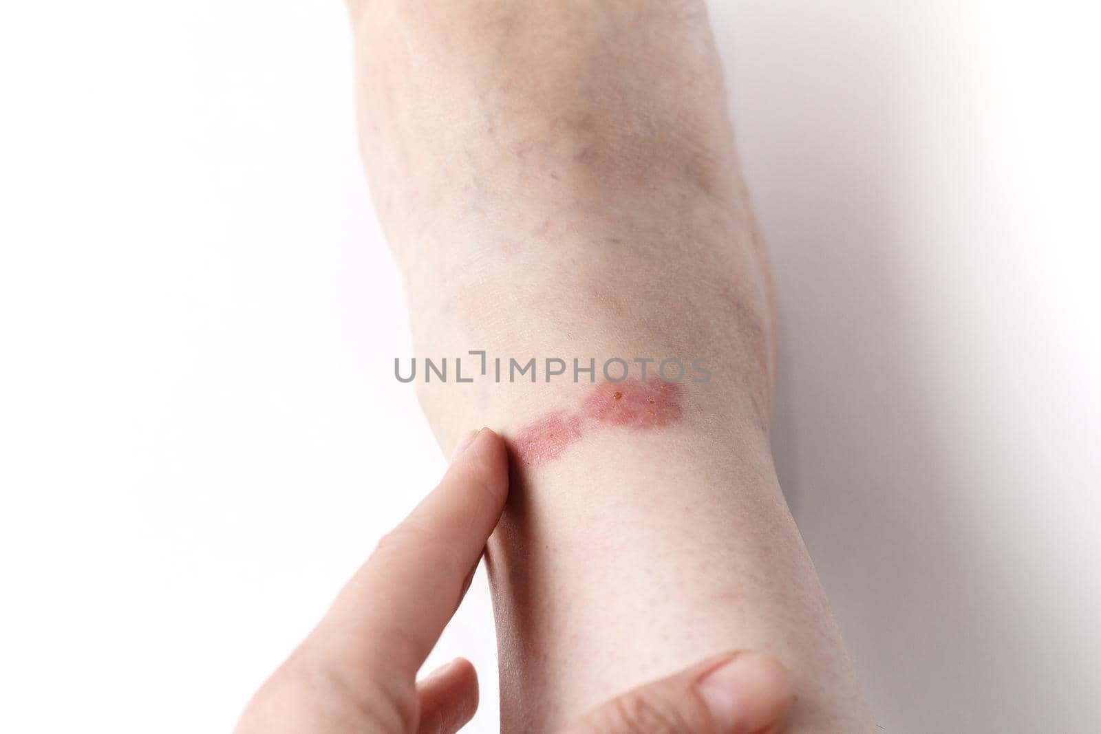 Redness on the skin of the leg from an insect bite. Copy space by lara29