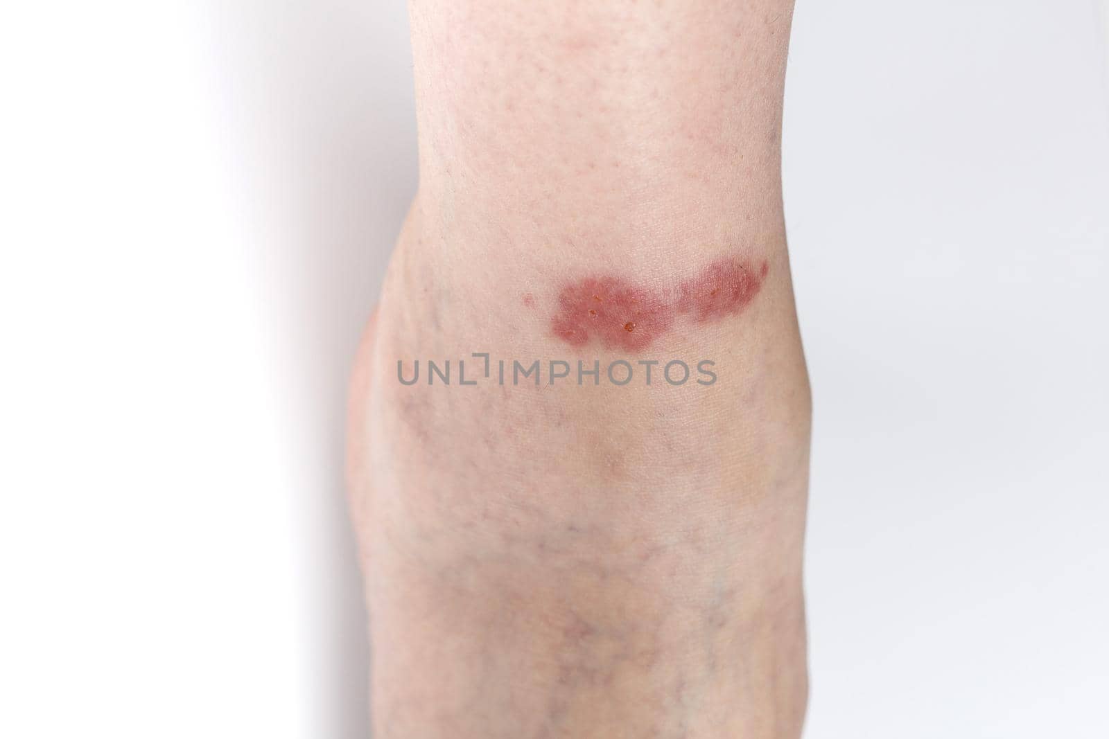 Redness on the skin of the leg from an insect bite. Copy space by lara29