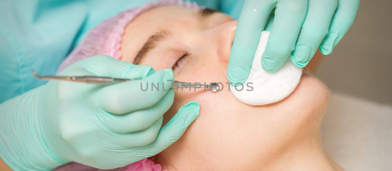 The beautician removes blackhead and acne on the female face in a beauty salon, blackhead removal tool. by okskukuruza