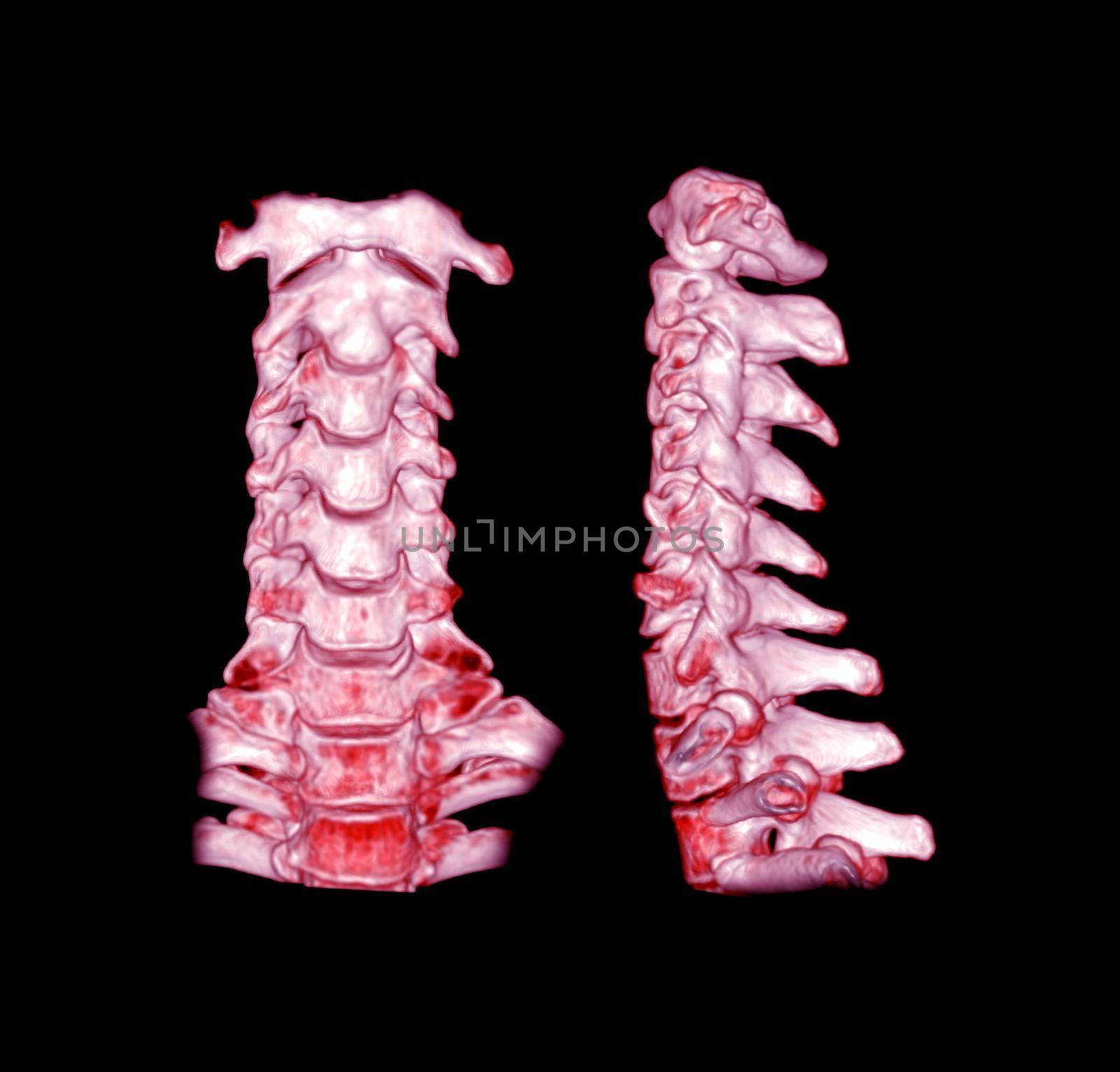 CT SCAN of Cervical Spine 3D rendering . by samunella