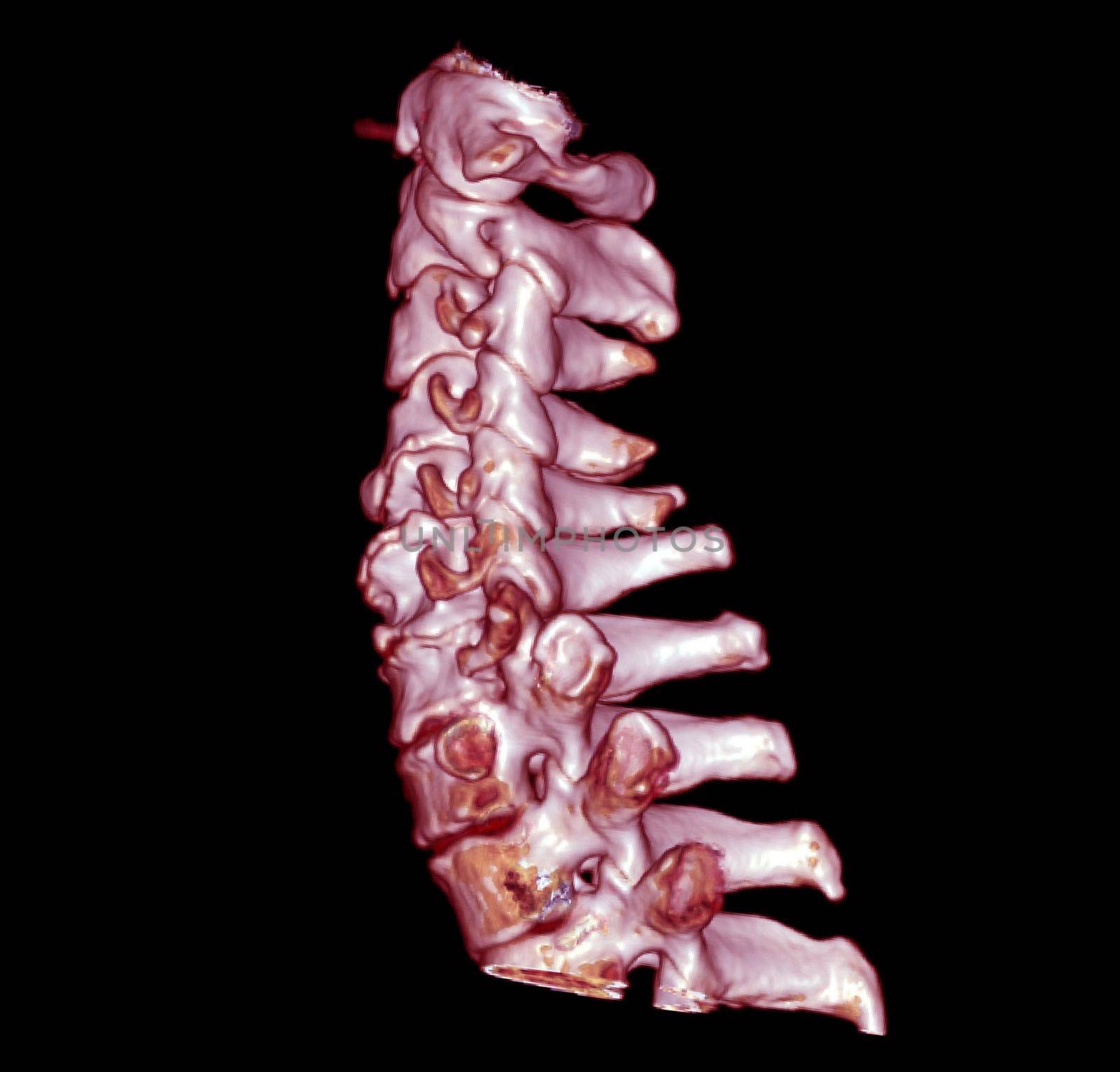 CT SCAN of Cervical Spine ( C-spine ) patient trauma case 3D rendering image .