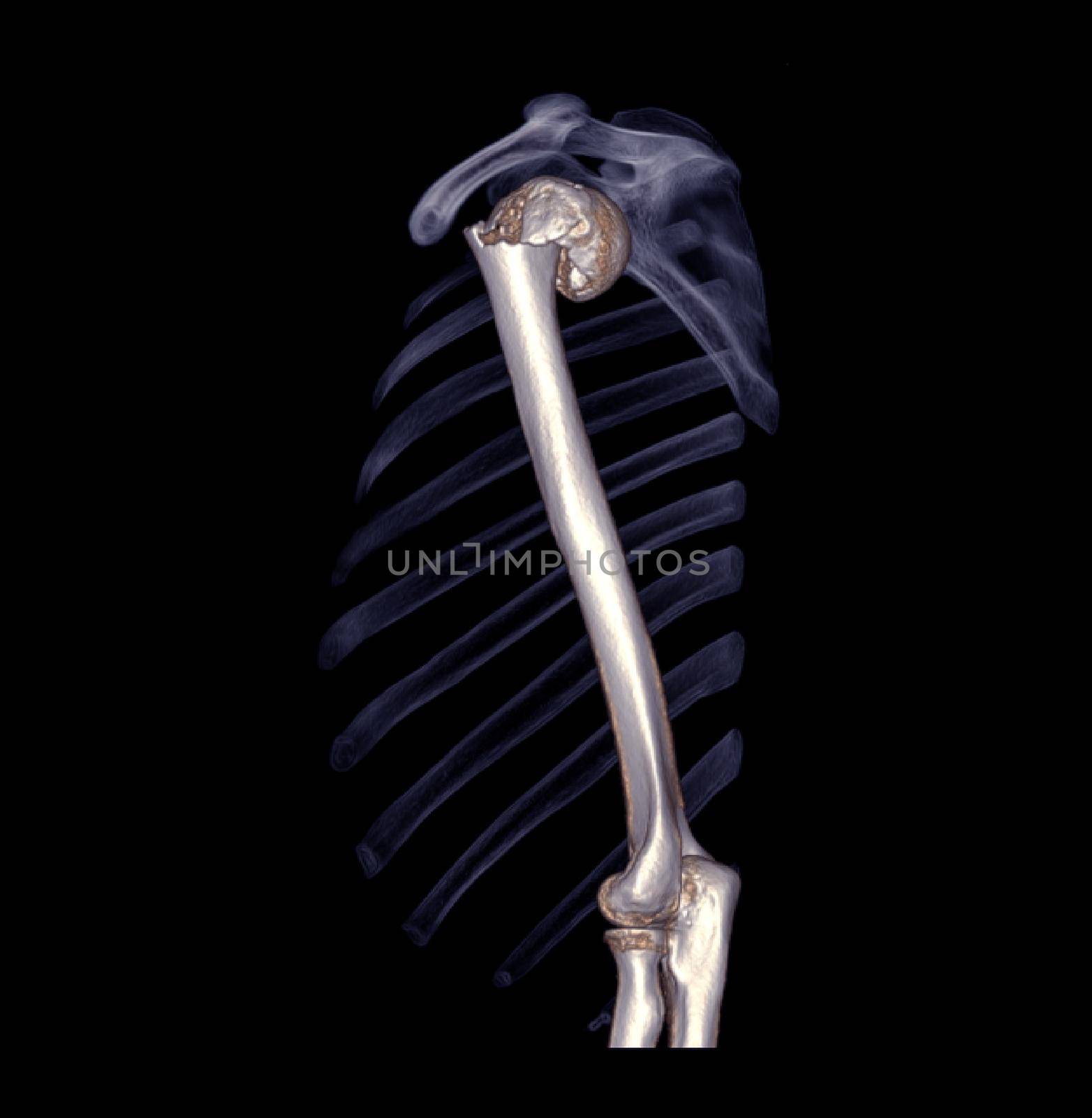 Computed Tomography Volume Rendering examination of the shoulder joint and humerus bone 3D rendering in patient fracture shoulder joint and humerus bone .