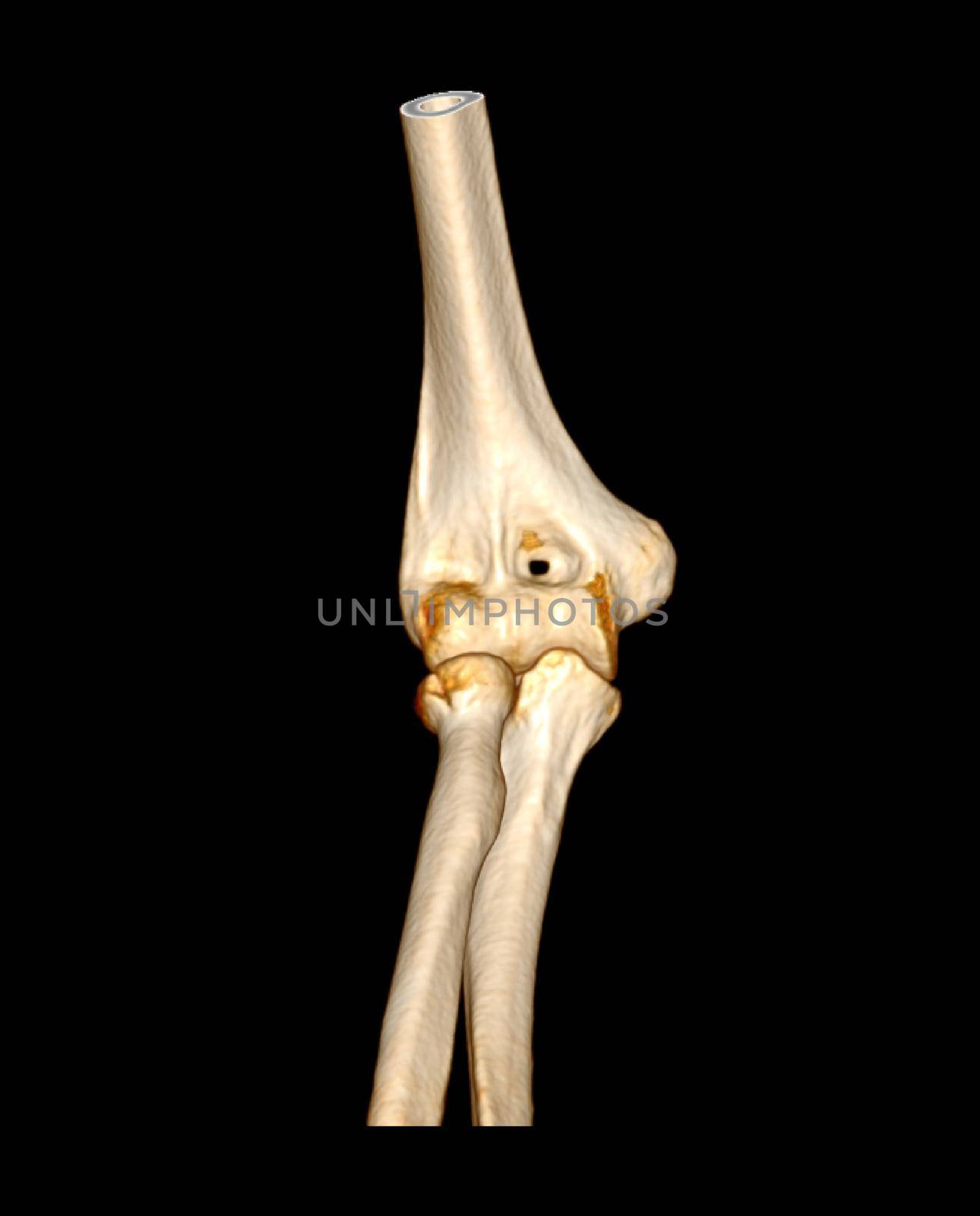 CT scan of elbow joint by samunella