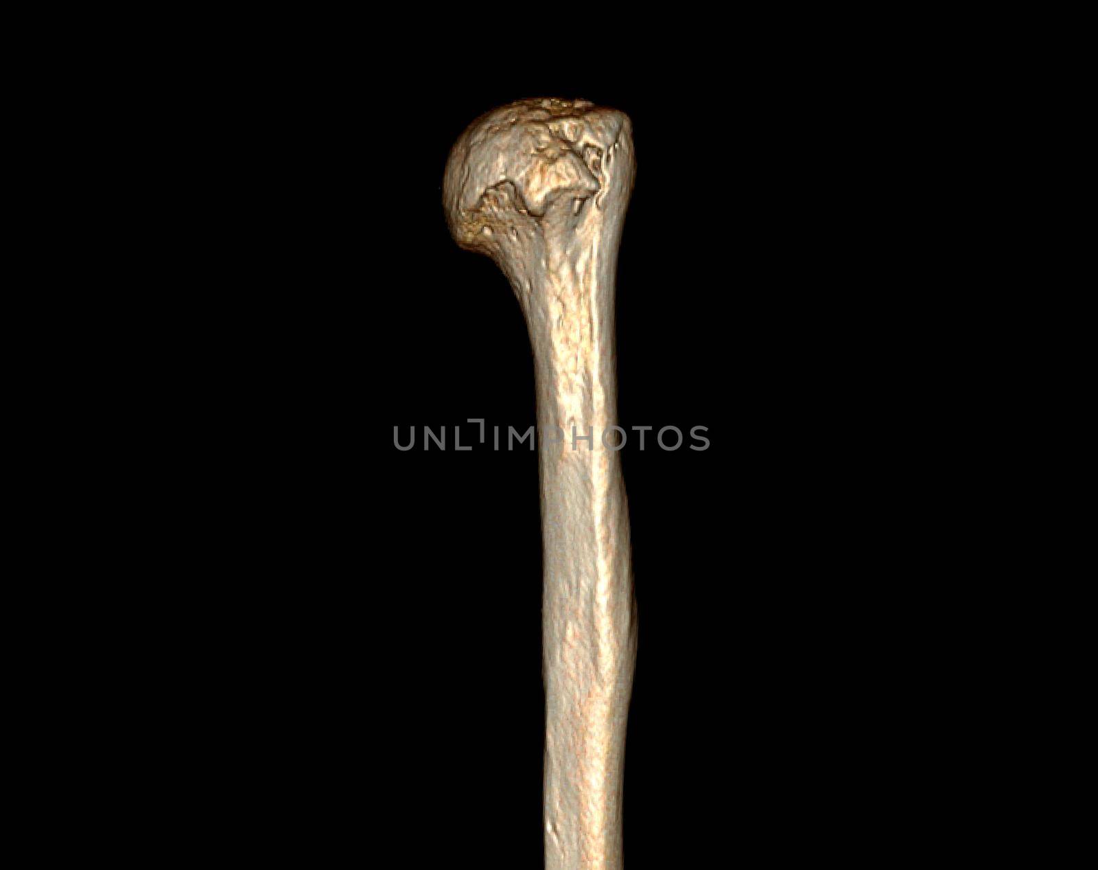 Computed Tomography Volume Rendering examination of the shoulder joint and humerus bone 3D rendering in patient fracture shoulder joint and humerus bone .