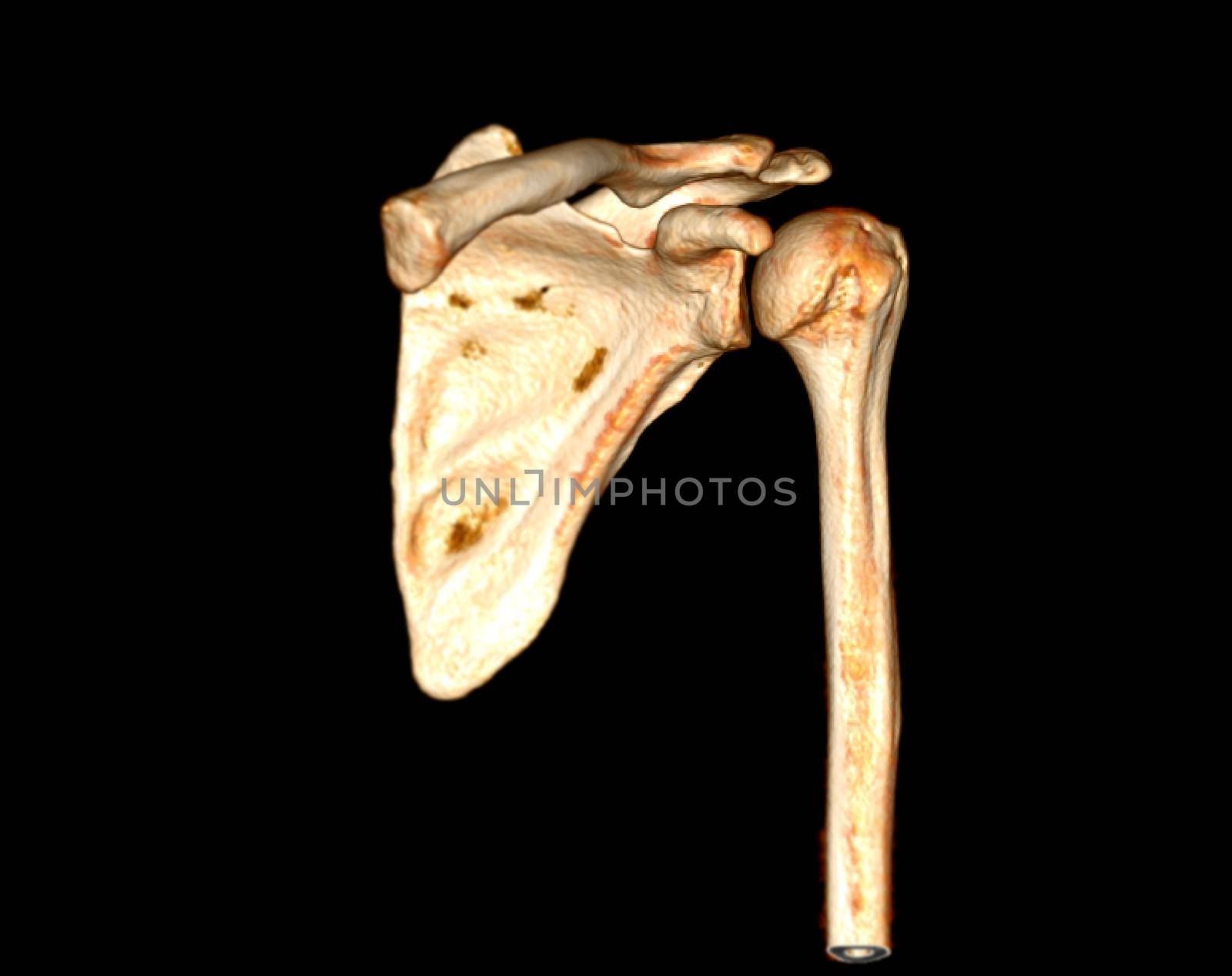 Computed Tomography Volume Rendering examination of the Shoulder 3D rendering in patient fracture shoulder joint.