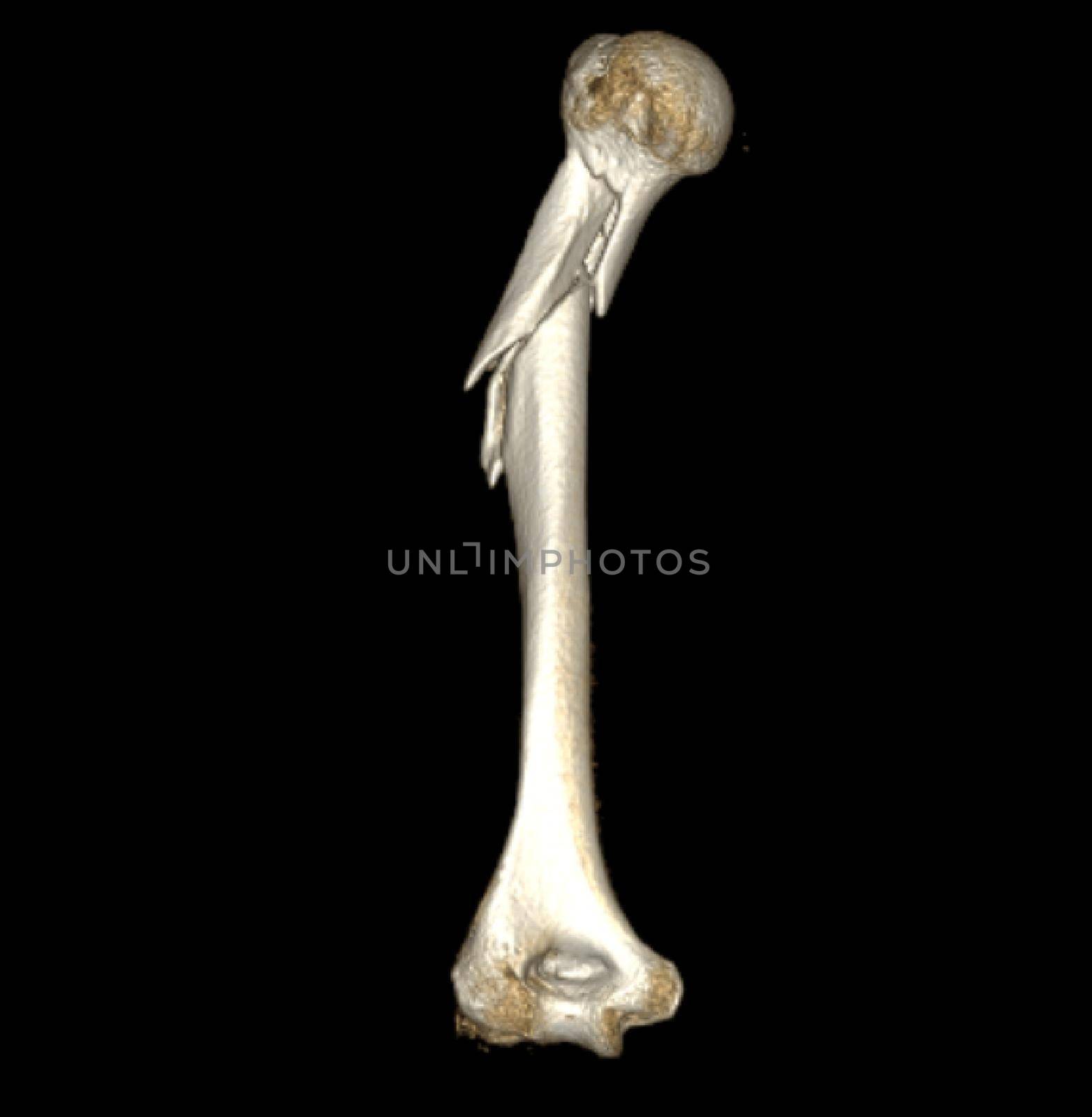 Computed Tomography Volume Rendering examination of the shoulder joint and humerus bone 3D rendering in patient fracture shoulder joint and humerus bone .